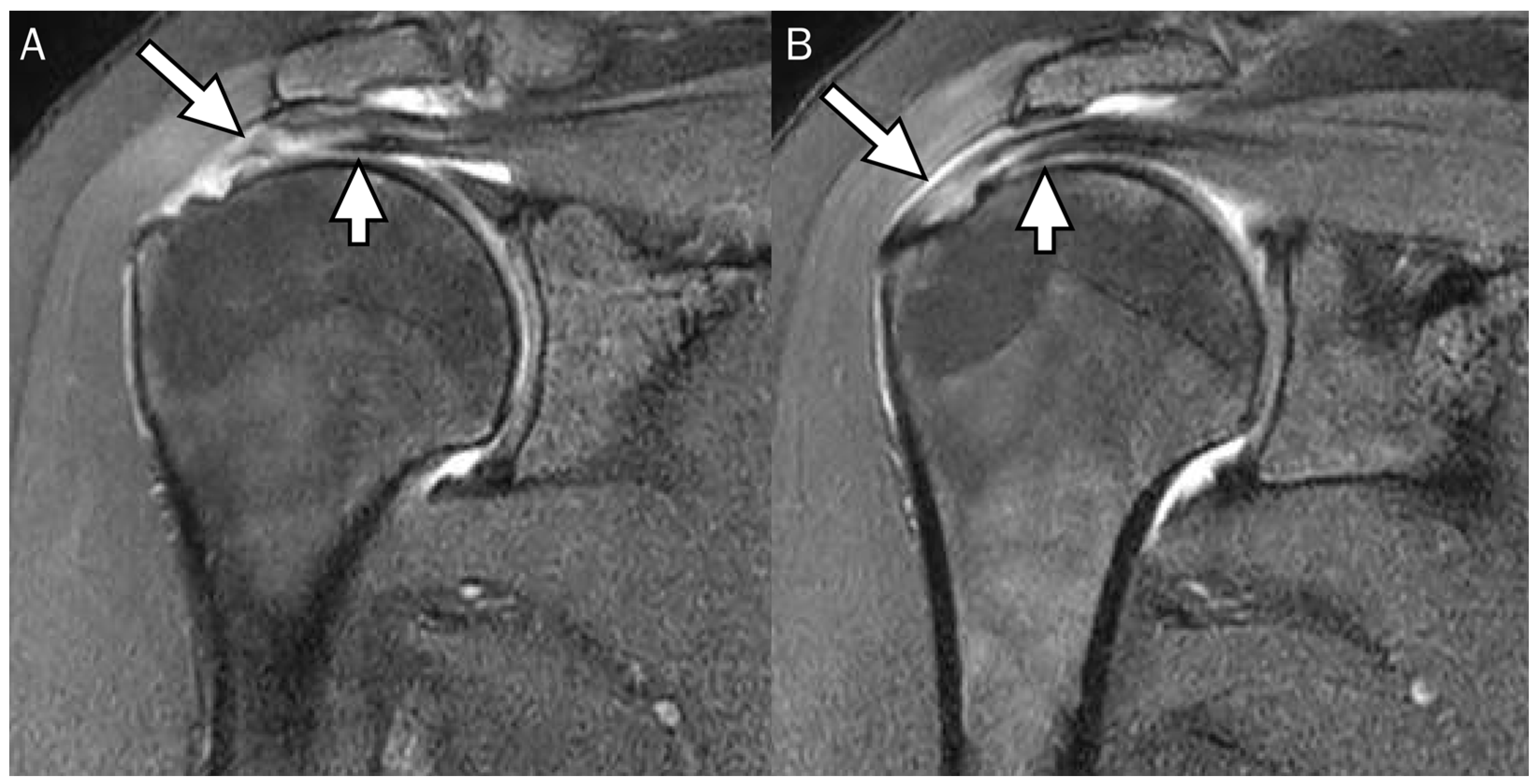 supraspinatus tear mri