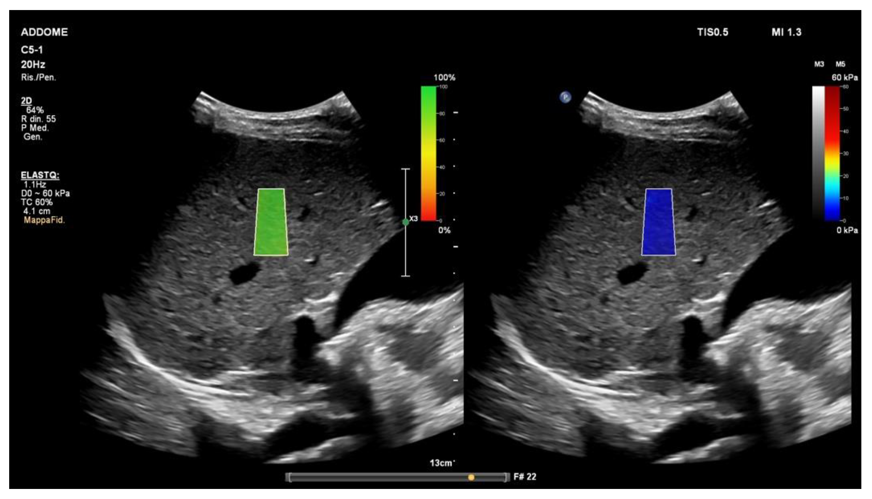 Diagnostics Free FullText Liver Ultrasound Elastography in Non