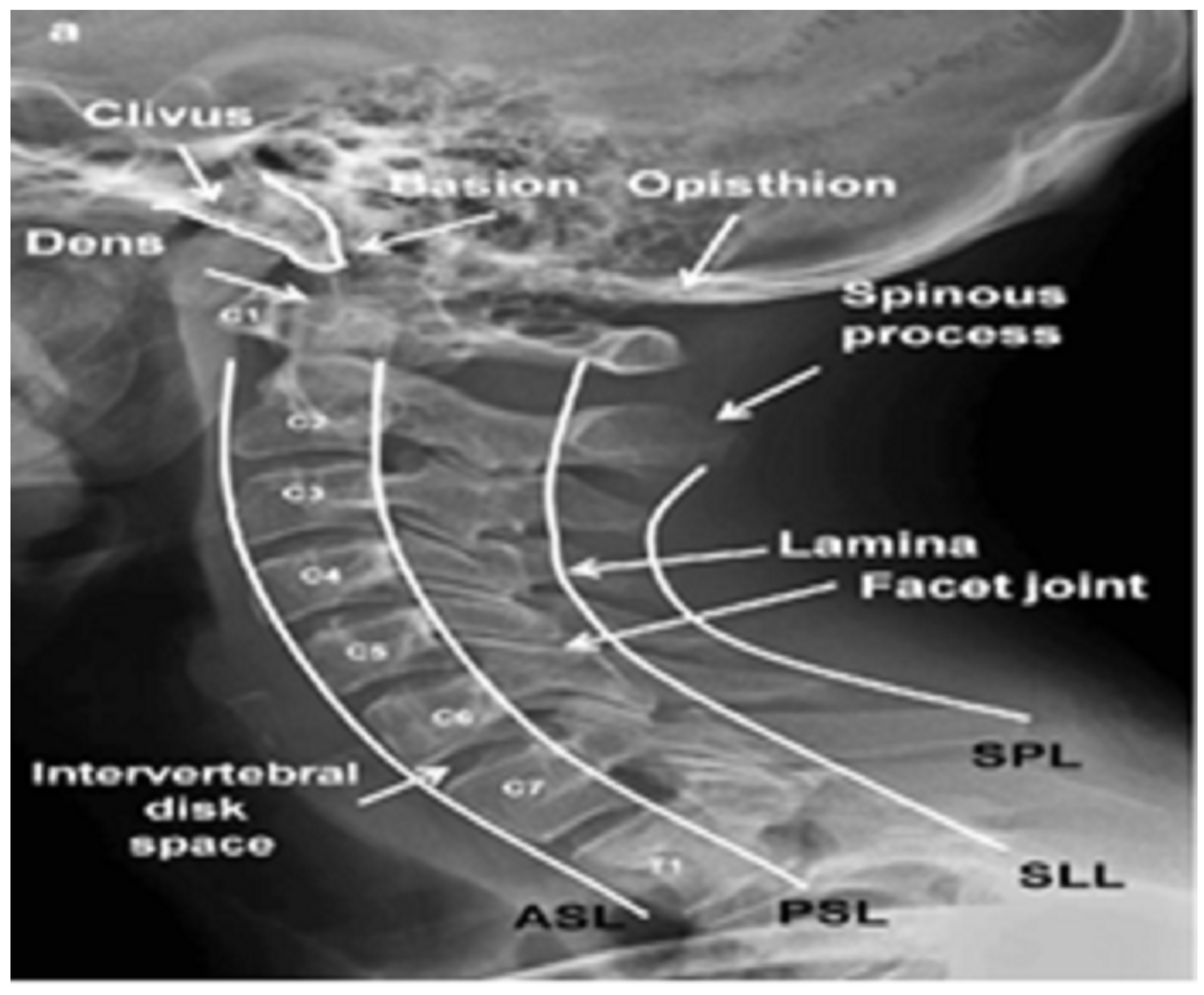 Classification of Cervical Spine Fracture and Dislocation Using Refined ...