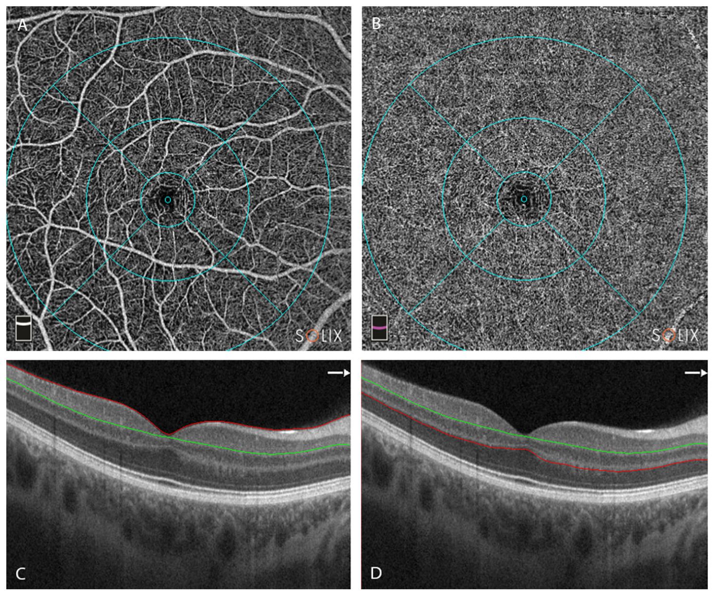 Diagnostics Free FullText Analysis of Optical Coherence Tomography
