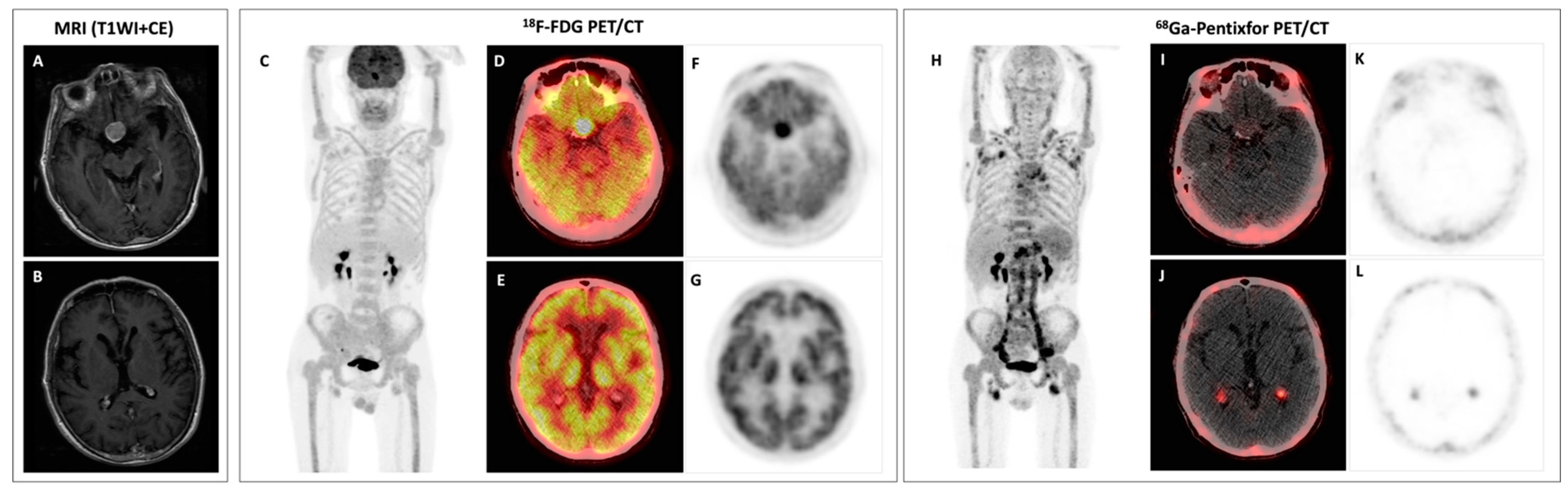 Bing–Neel Syndrome and Coexisting Pituitary Macroadenoma in