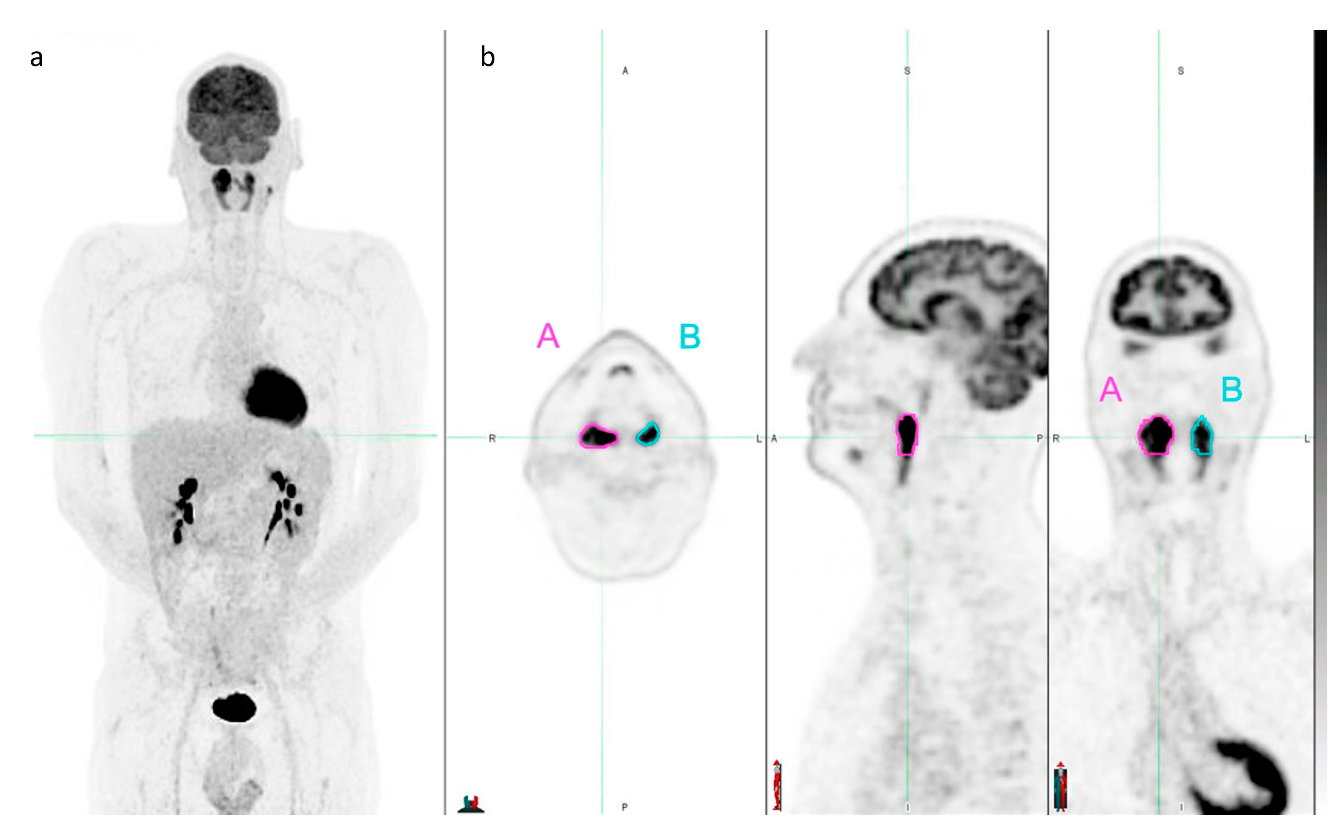 Baseline 18F-FDG PET/CT Radiomics in Classical Hodgkin's