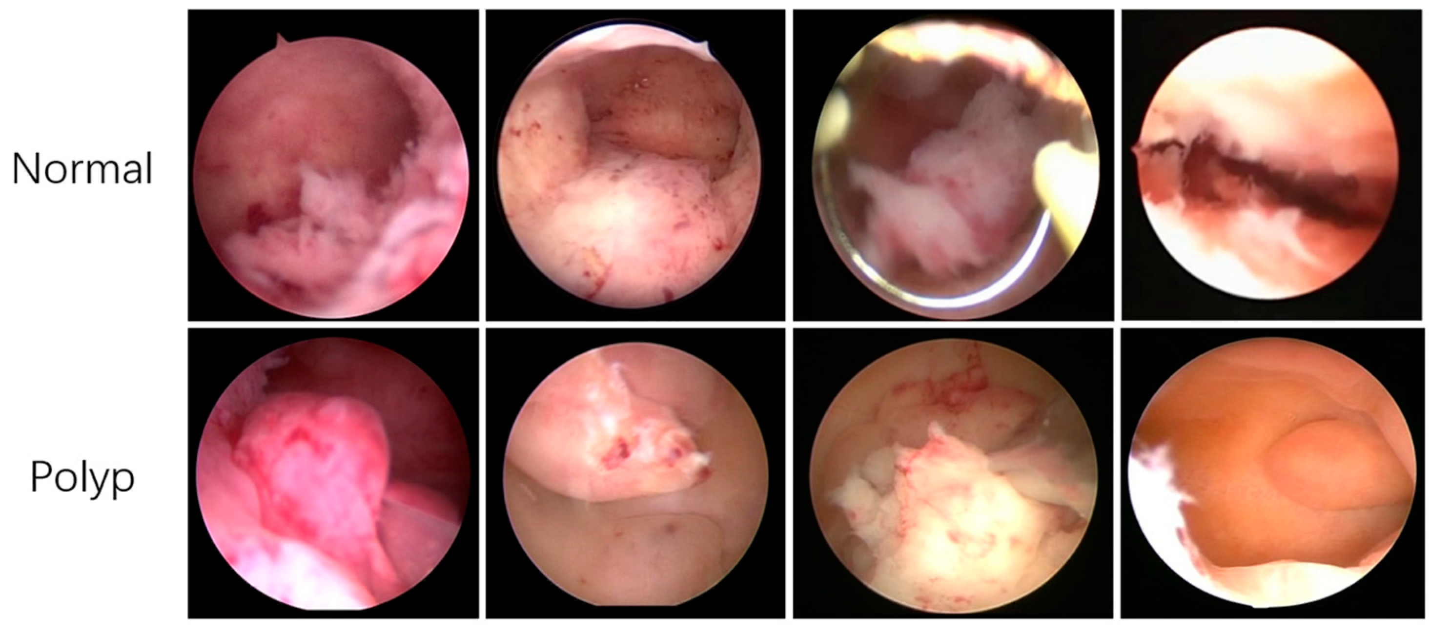 Diagnostics | Free Full-Text | Automated Detection of Endometrial Polyps  from Hysteroscopic Videos Using Deep Learning