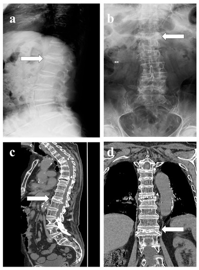Vertebra Plana: A Narrative Clinical and Imaging Overview