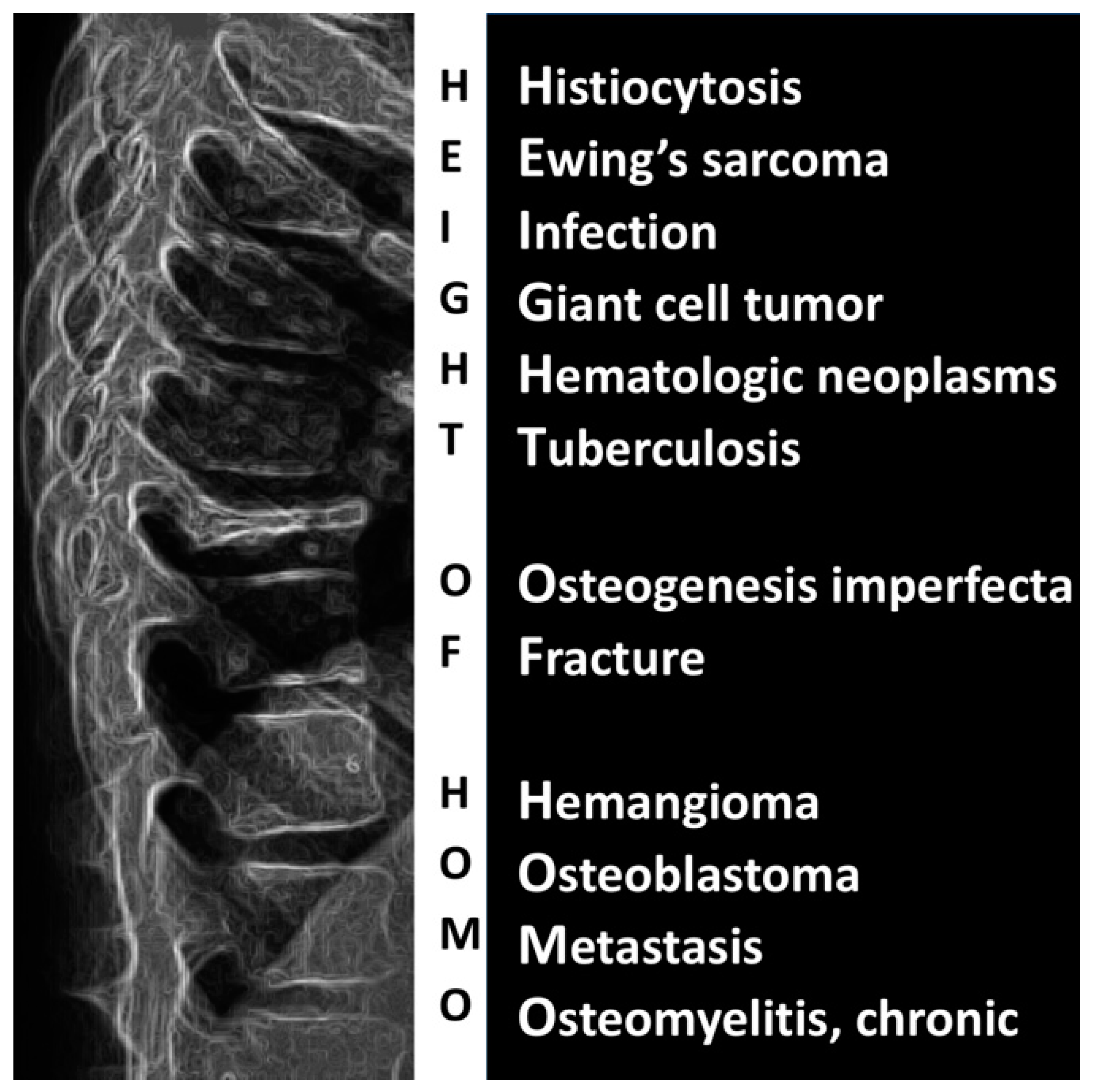 Diagnostics Free FullText Vertebra Plana A Narrative Clinical and