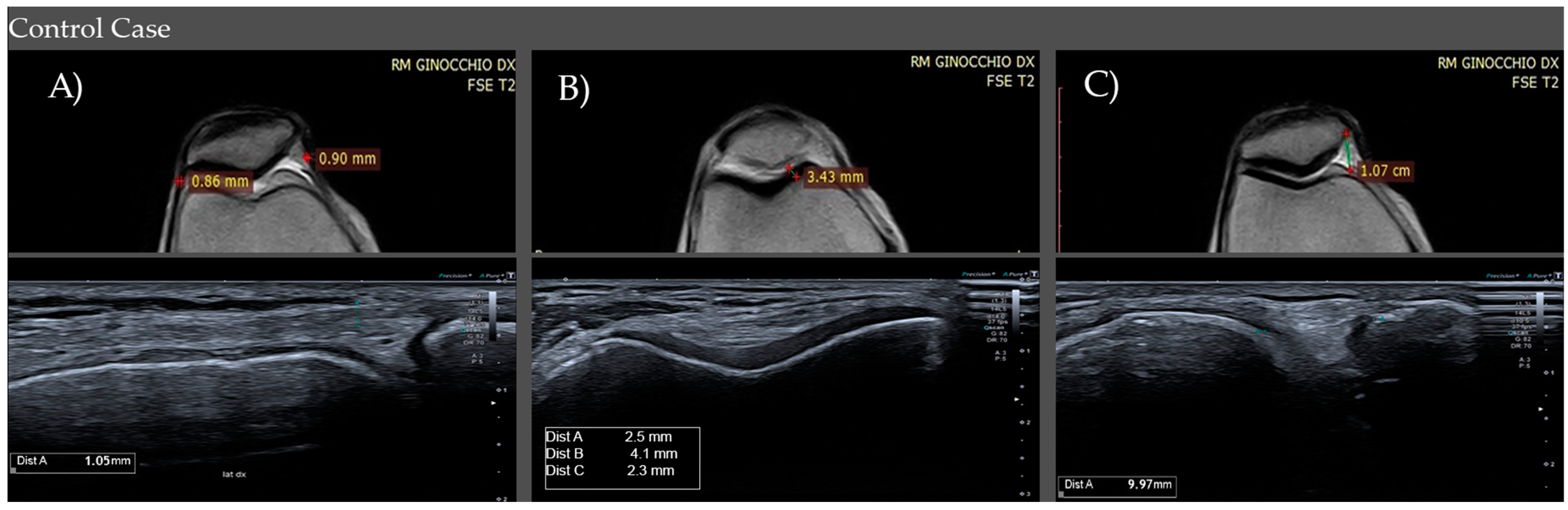 Patella femoral syndrome discount