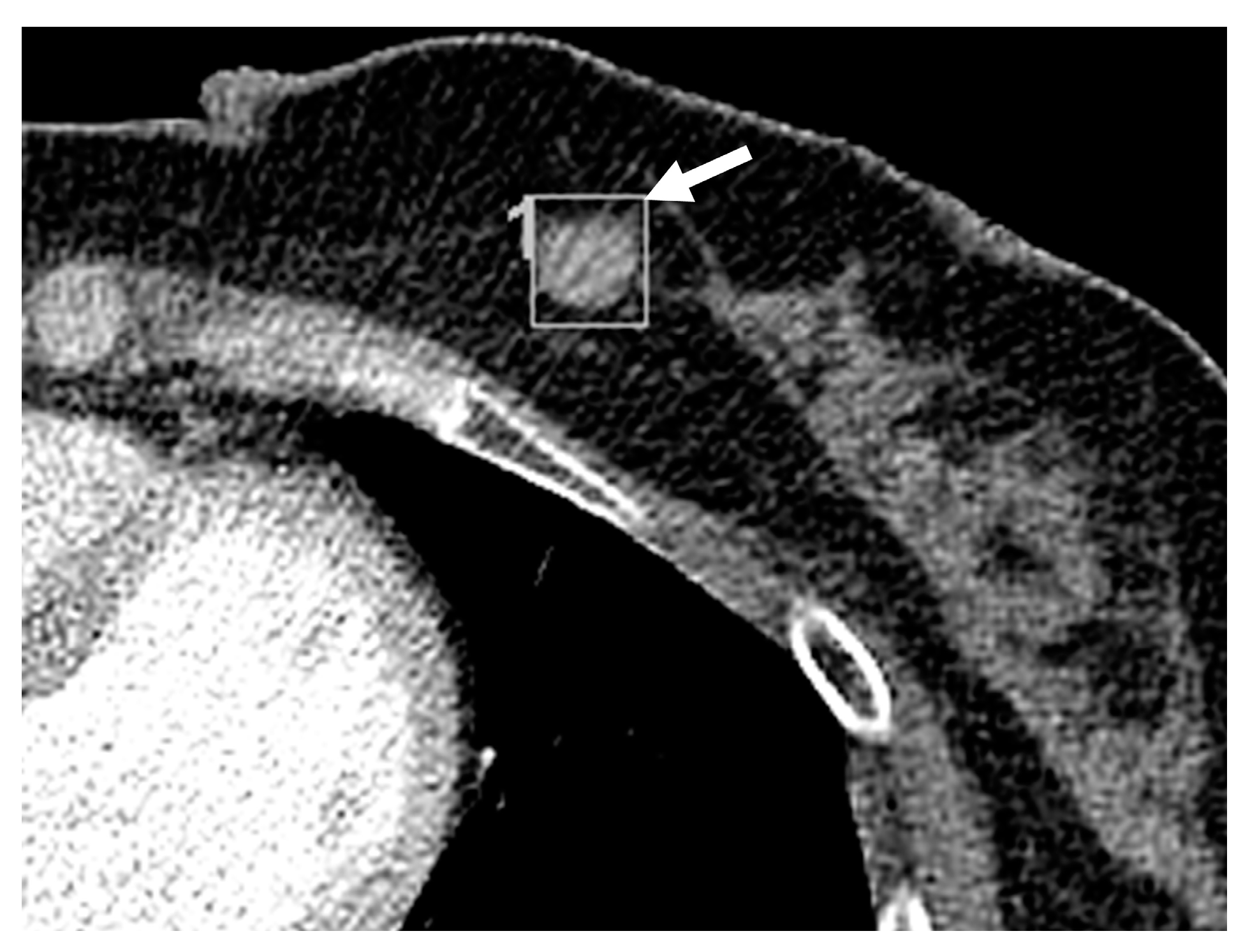 Diagnostic Breast Imaging 第2版 Breast Imaging: Diagnosis