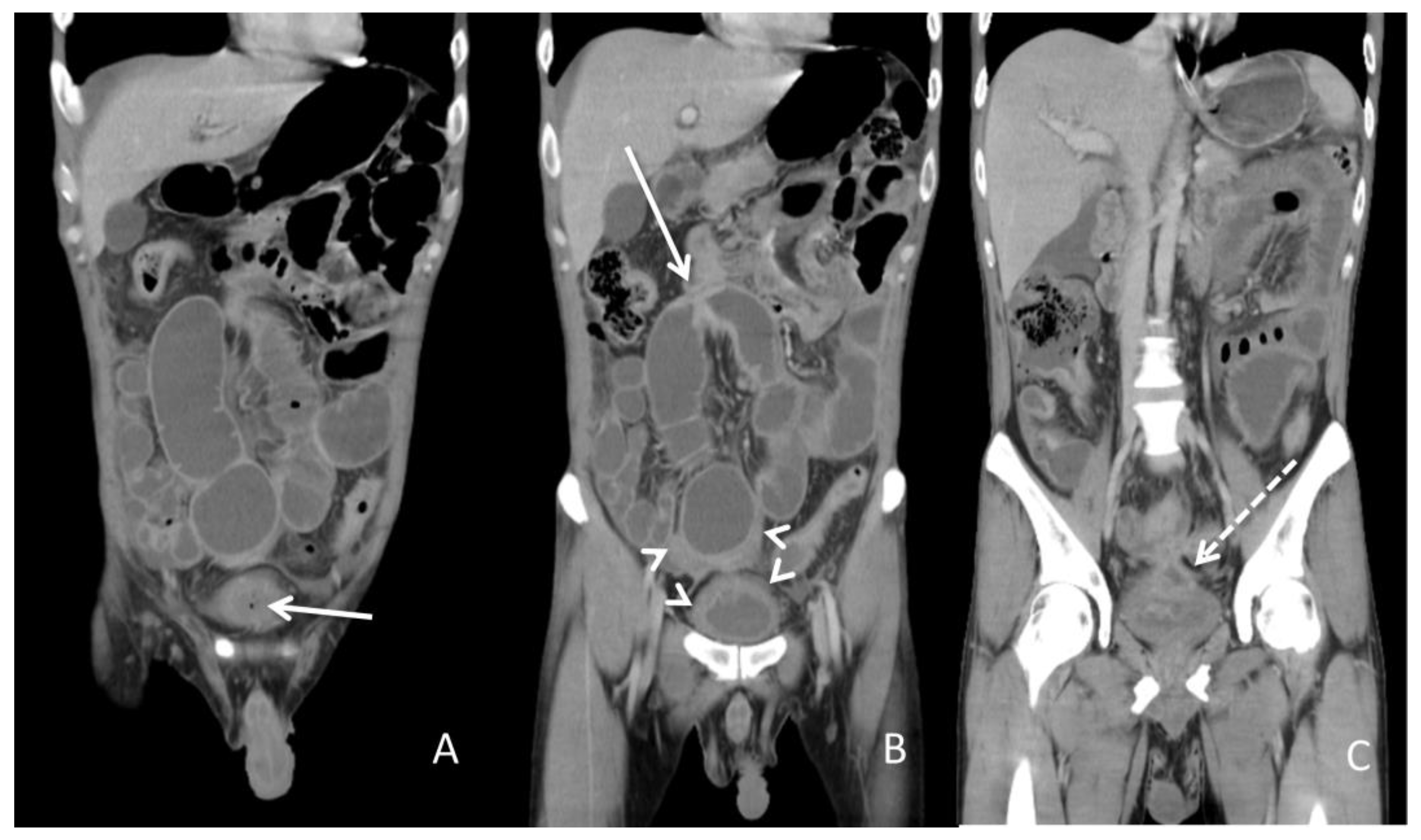 Big Fistula Porn Video - Diagnostics | Free Full-Text | Management of Enterovesical Fistula in a  Patient with Crohn’s Disease: A Case Report and Literature Review