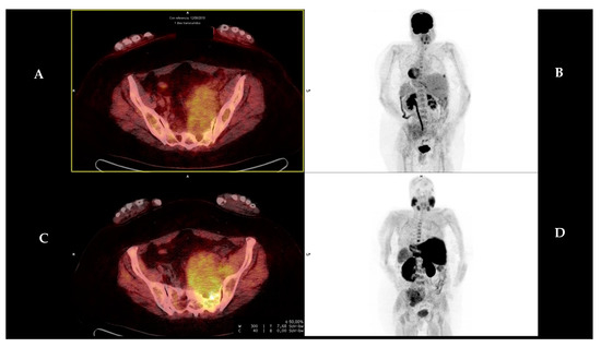 Multitracer PET/CT with [18F]Fluorodeoxiglucose and [18F