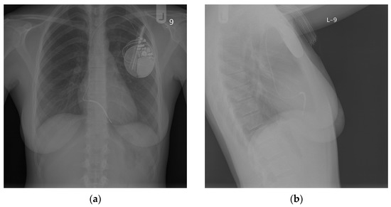 Application of Novel Technologies in Cardiac Electrotherapy to Prevent ...