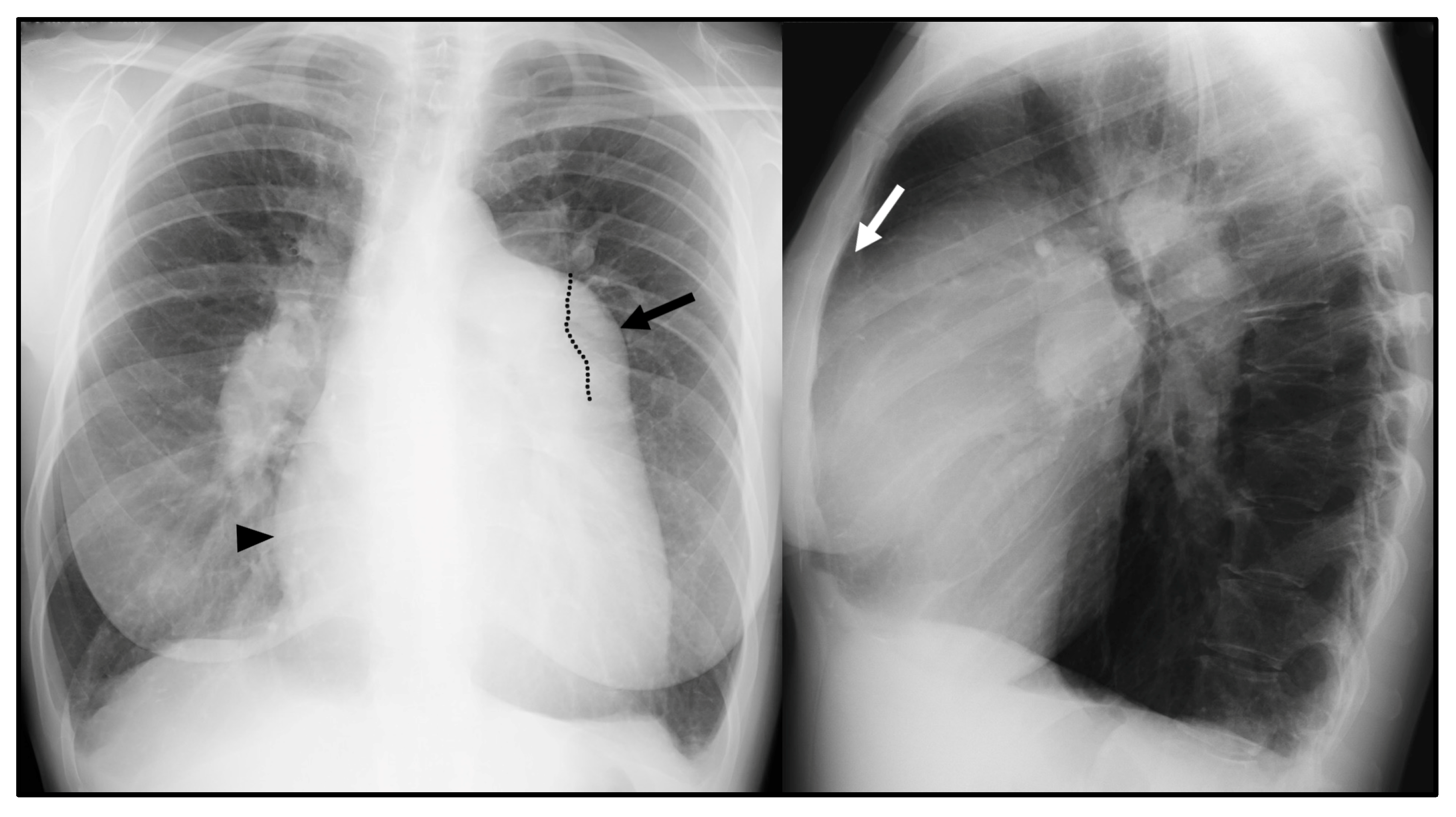 diagnostics-free-full-text-pulmonary-hypertension-in-chronic-lung