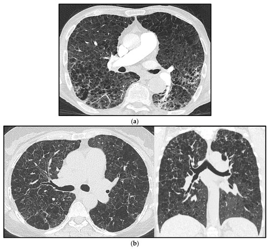 Diagnostics Free FullText Pulmonary Hypertension in Chronic Lung