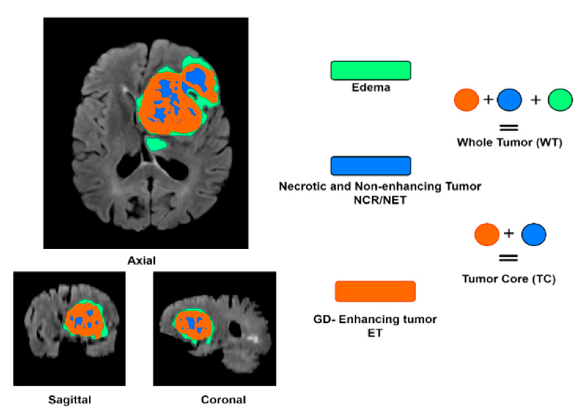 Brain tumor segmentation based on deep learning and an attention mechanism  using MRI multi-modalities brain images