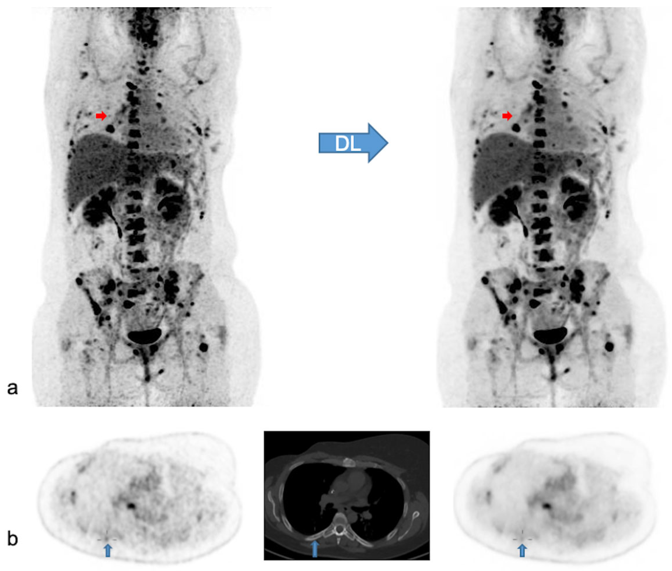 Deep Learning Denoising Improves and Homogenizes Patient [18F]FDG PET ...