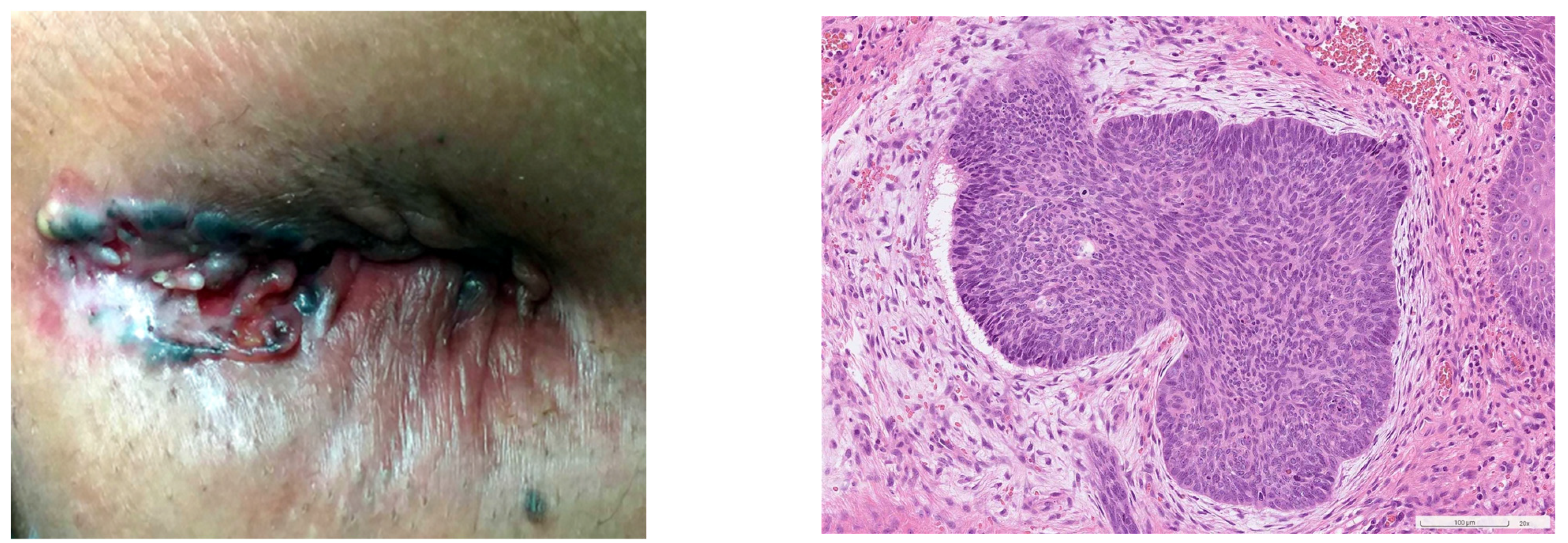 Diagnostics | Free Full-Text | Perianal Basal Cell Carcinoma&mdash;A  Systematic Review and Meta-Analysis of Real-World Data