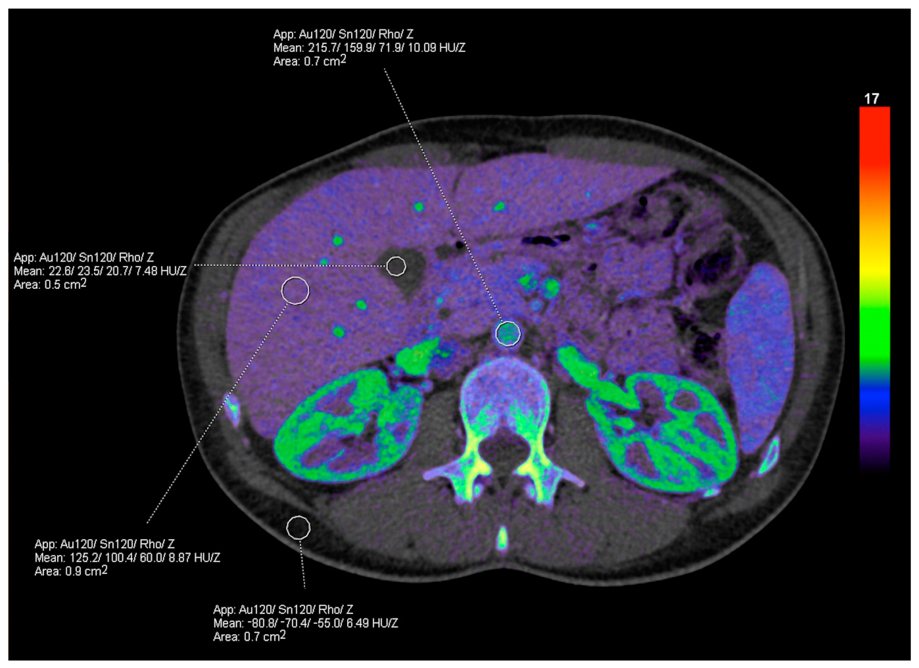 Spectral CT: Current Liver Applications