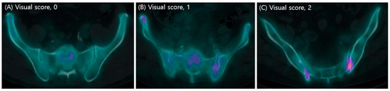 Visual Scoring of Sacroiliac Joint/Sacrum Ratios of Single-Photon ...