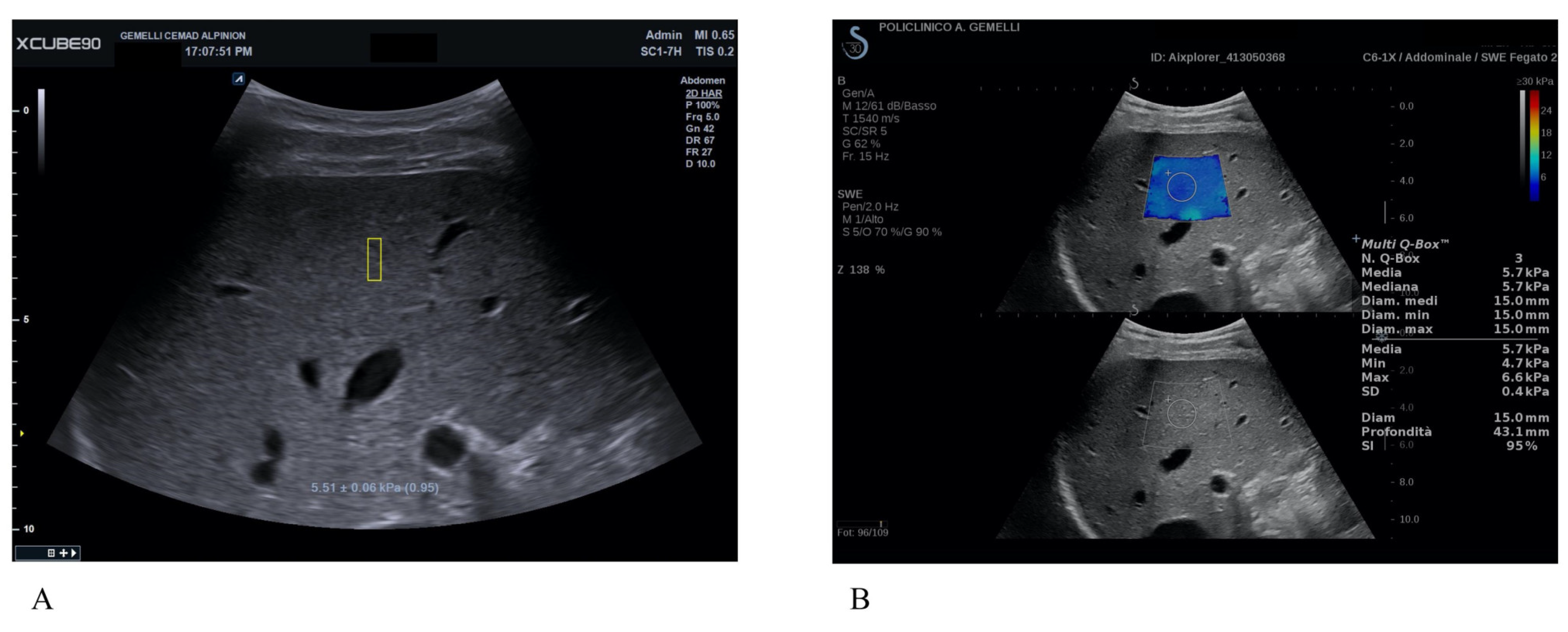 Correlation between a New PointShear Wave Elastography Device (X+pSWE