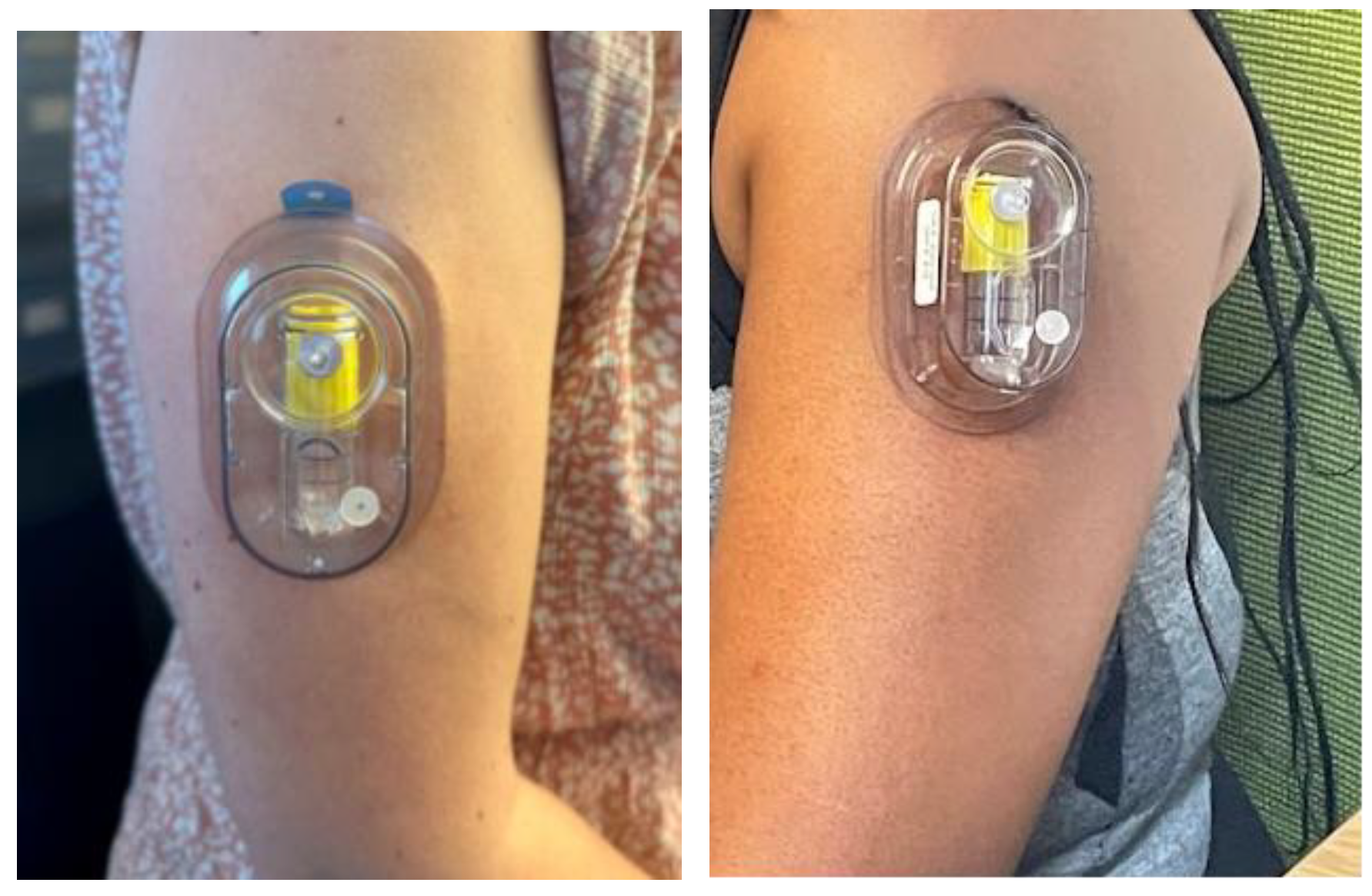 Diagnostics Free FullText Painless Capillary Blood Collection A
