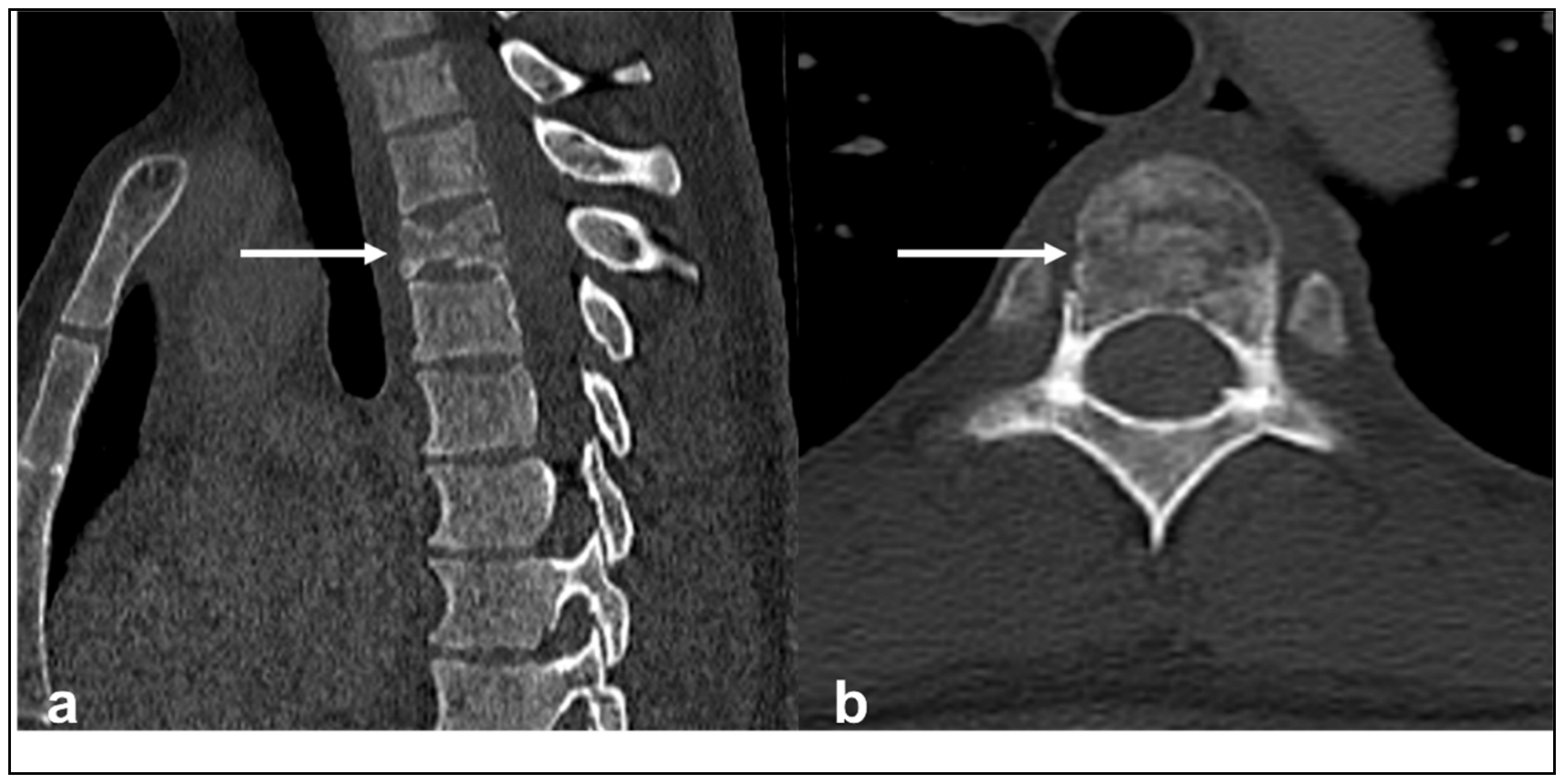 Spinal Cancer: What You Should Know