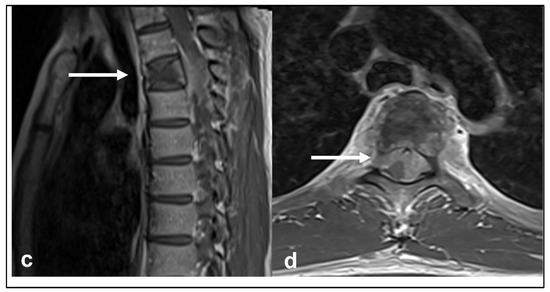 Primary Osseous Malignancies of the Spine
