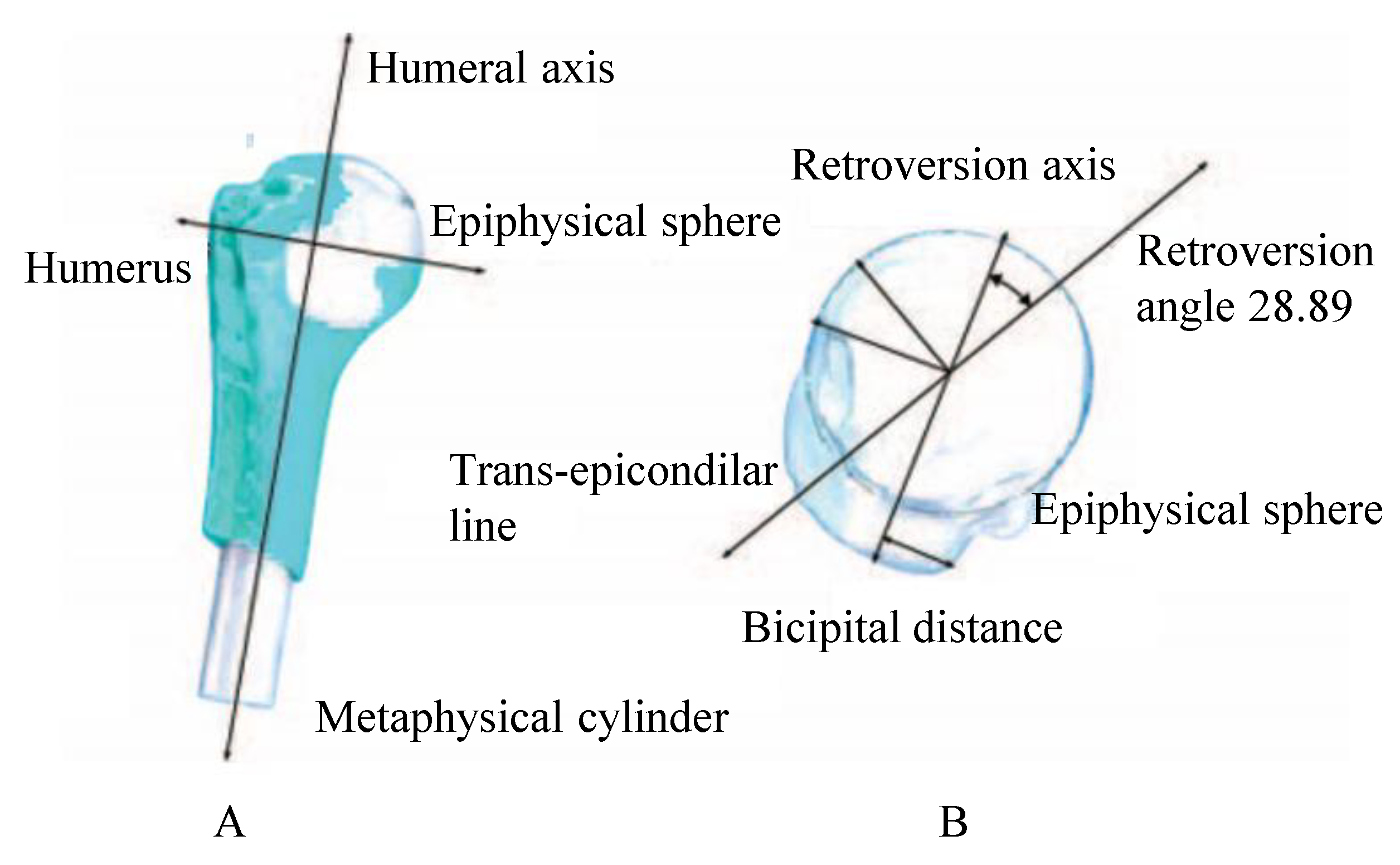 Humeral Nail System