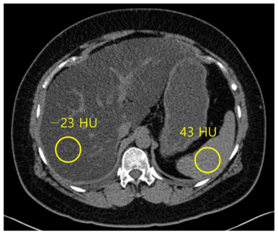 gabapentin fatty liver