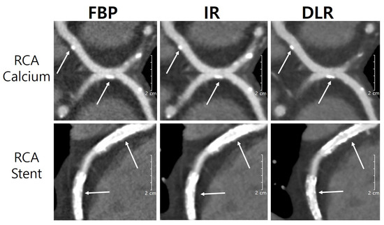 Assessment of Image Quality of Coronary CT Angiography Using Deep ...