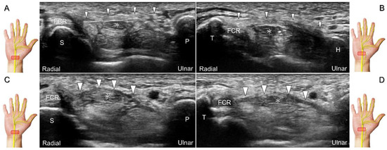 Ultrasound Imaging and Guidance for Distal Peripheral Nerve Pathologies ...