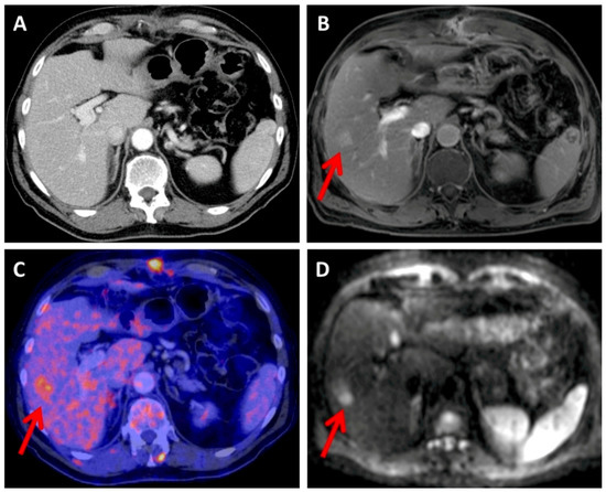 Whole-Body Magnetic Resonance Imaging (MRI) for Staging Melanoma ...