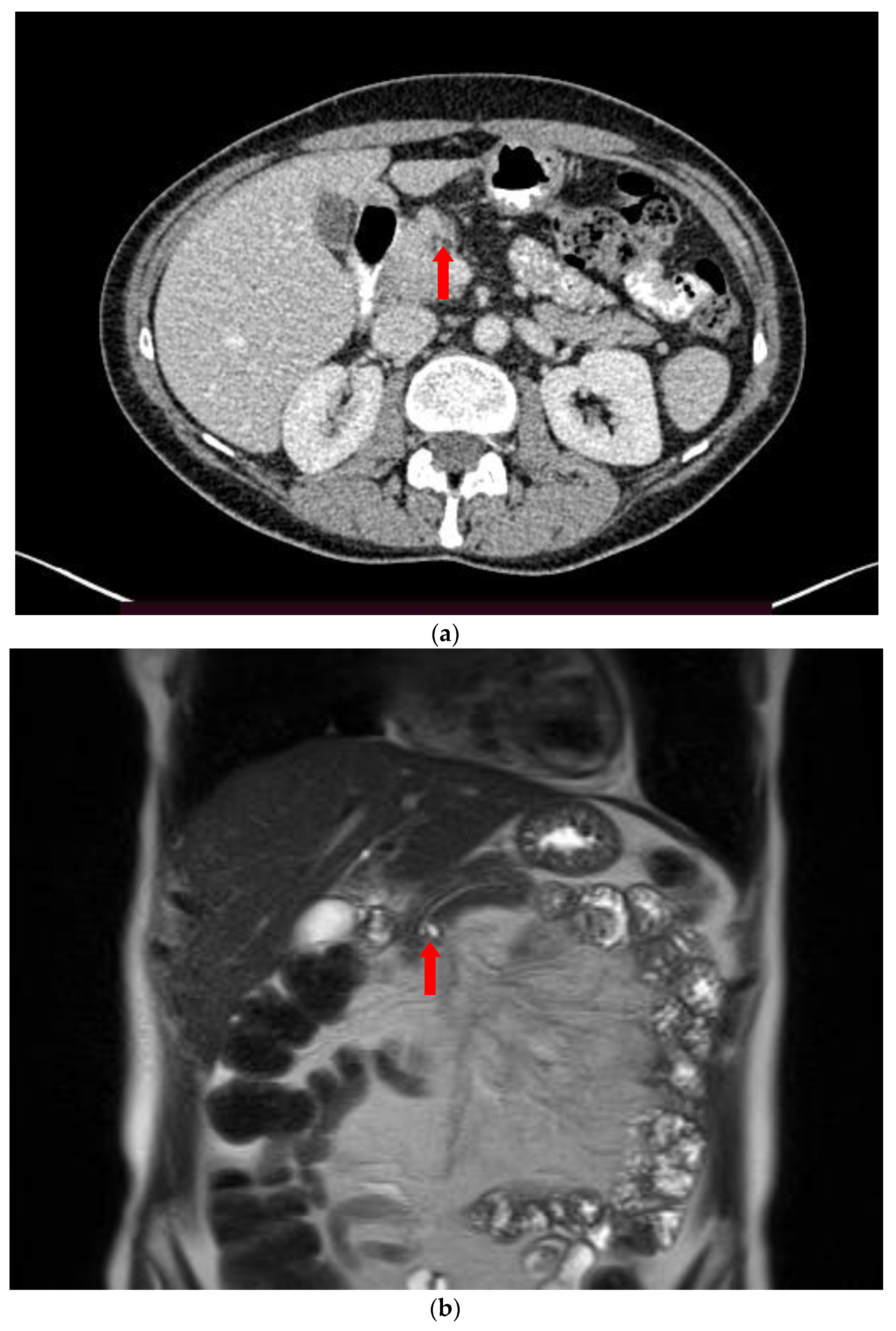 Diagnostics | Free Full-Text | Intraductal Papillary Mucinous Neoplasm of  the Pancreas: A Challenging Diagnosis