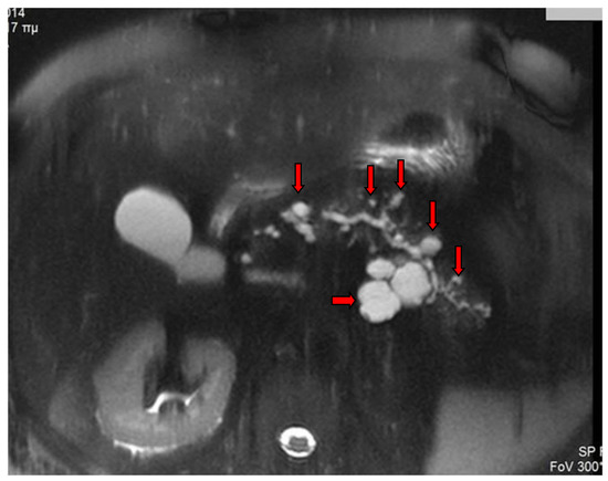 Intraductal Papillary Mucinous Neoplasm of the Pancreas: A Challenging ...