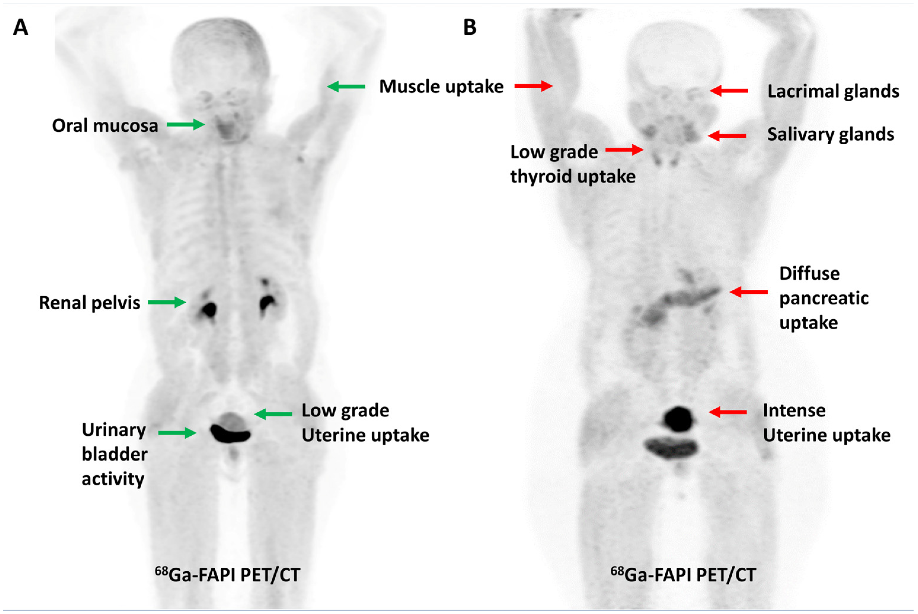 PET Imaging of Fibroblast Activation Protein in Various Types of Cancer  Using 68Ga-FAP-2286: Comparison with 18F-FDG and 68Ga-FAPI-46 in a  Single-Center, Prospective Study