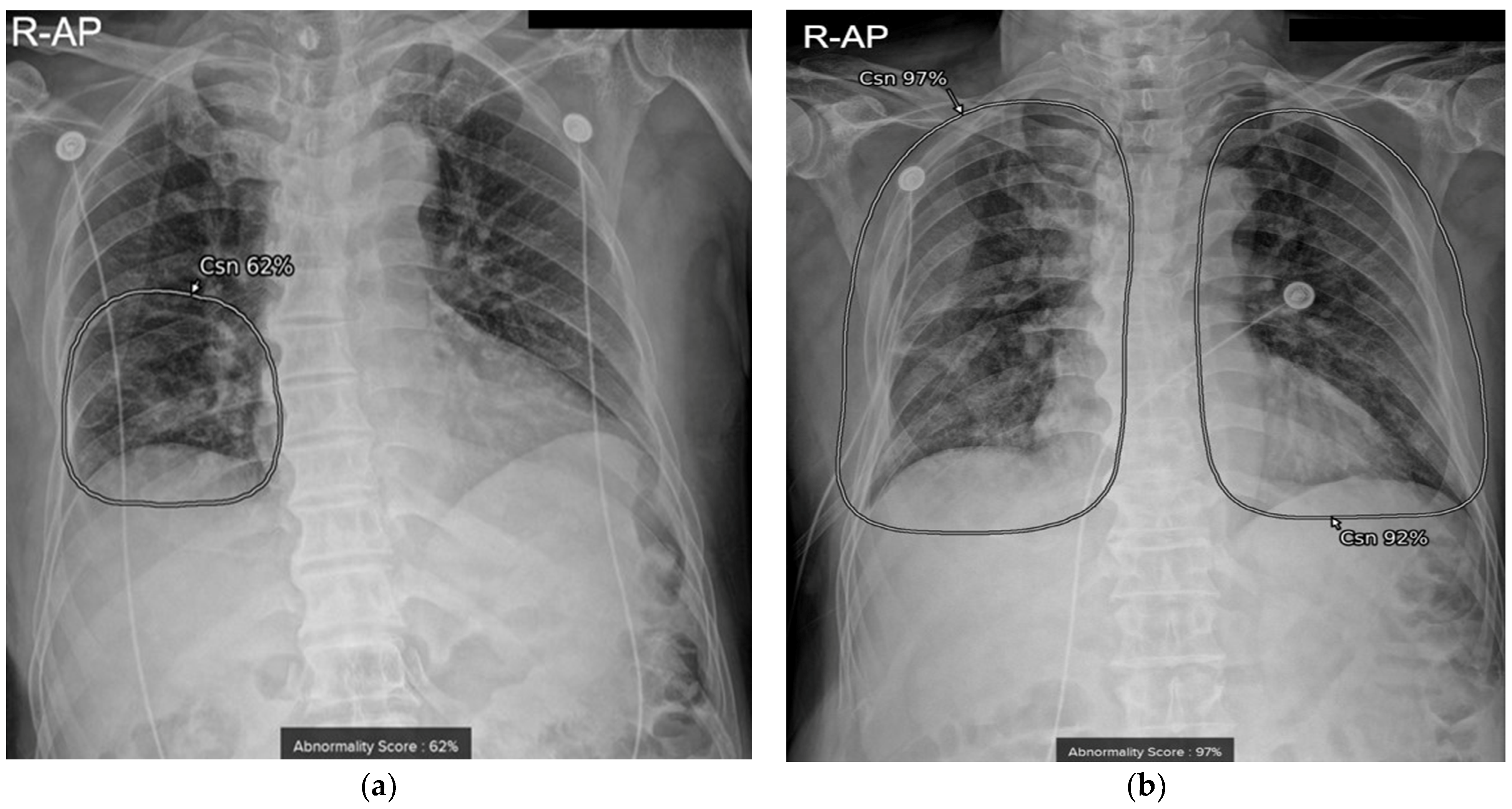 Clinical Implication and Prognostic Value of Artificial 