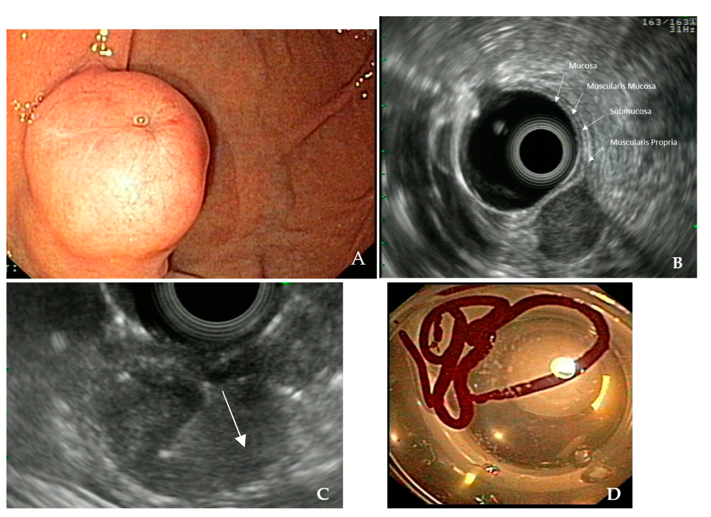 EUS-Guided Diagnosis of Gastric Subepithelial Lesions, What Is New?