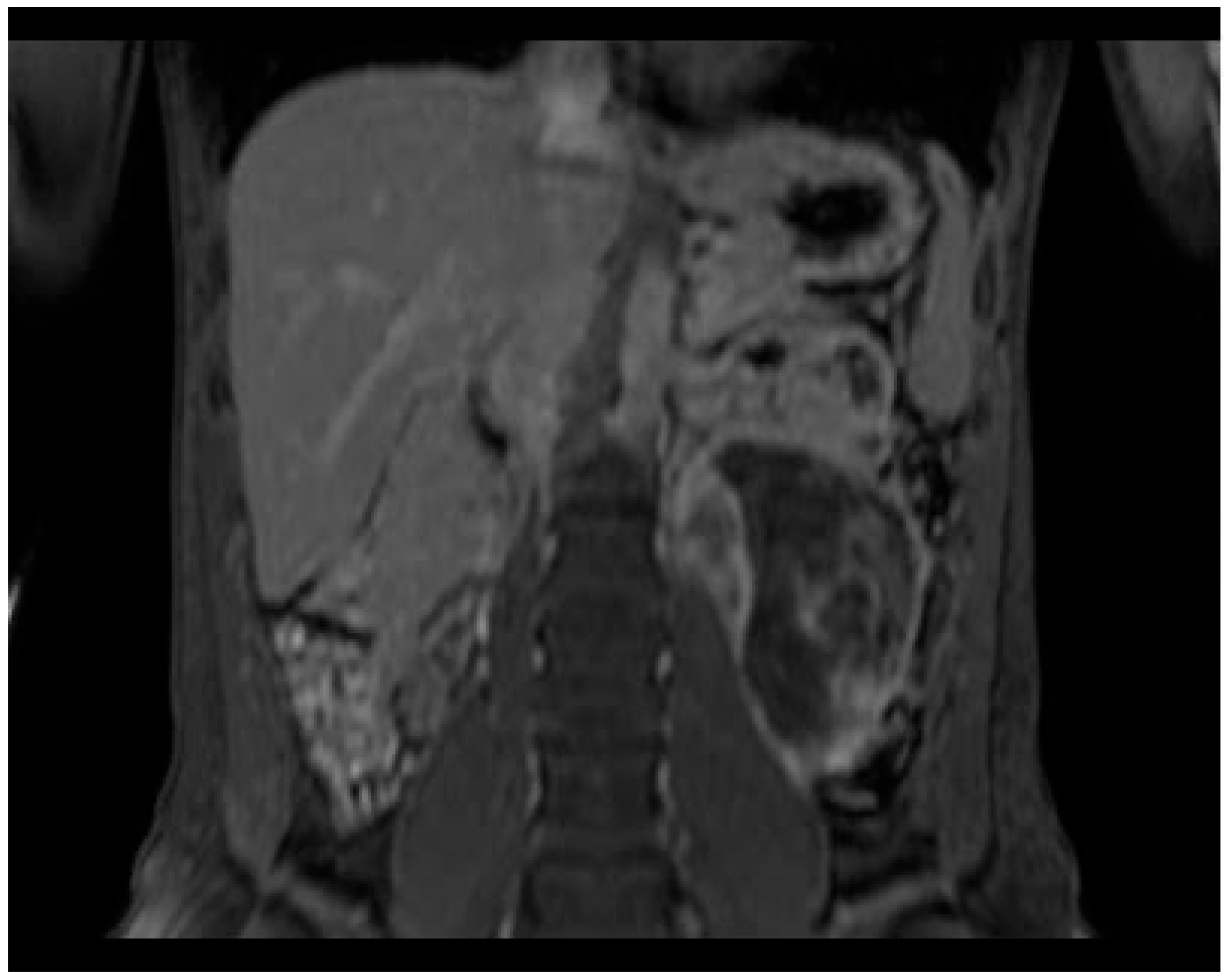 Ganglioneuroma Radiology