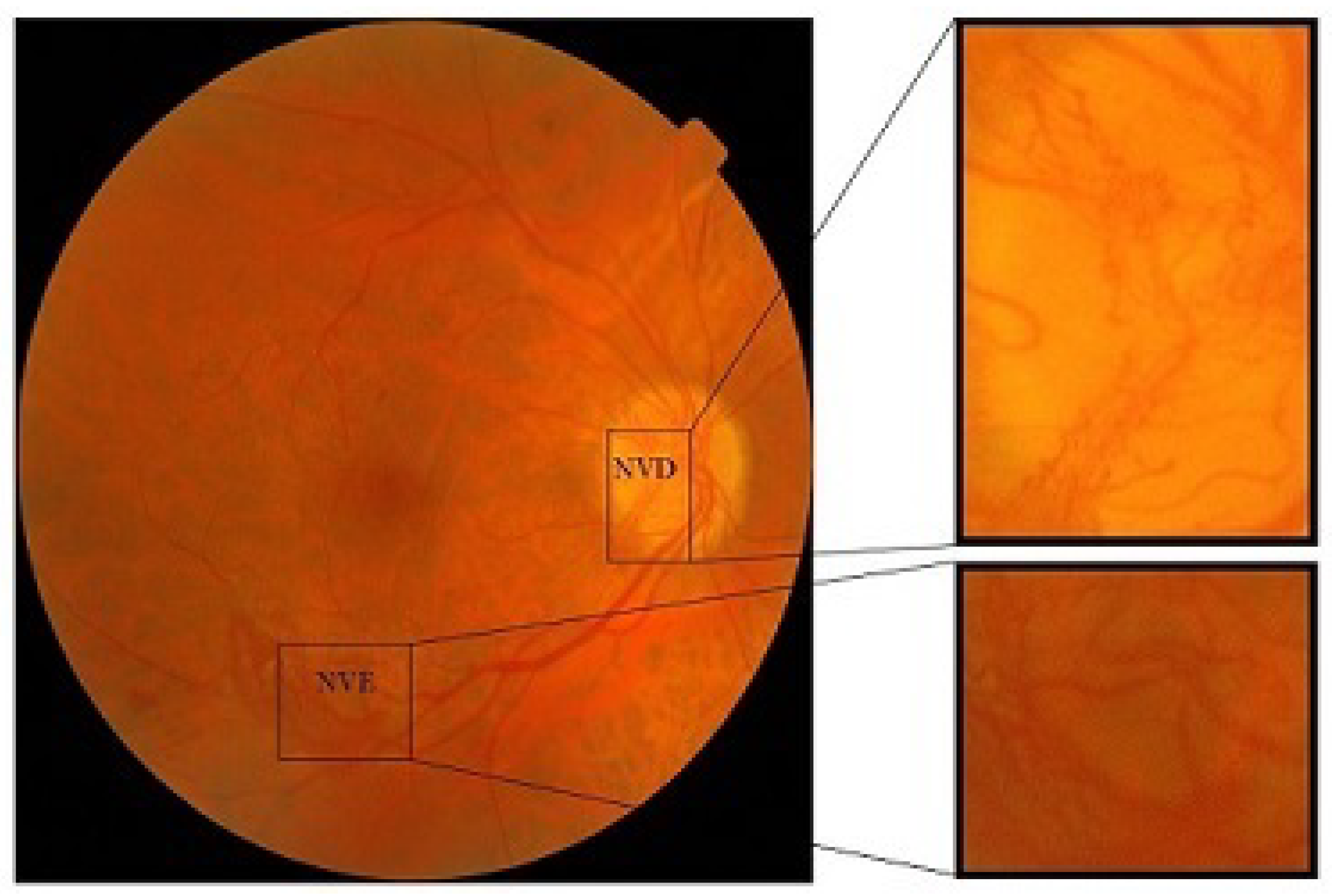 Diagnostics Free FullText Proliferative Diabetic Retinopathy