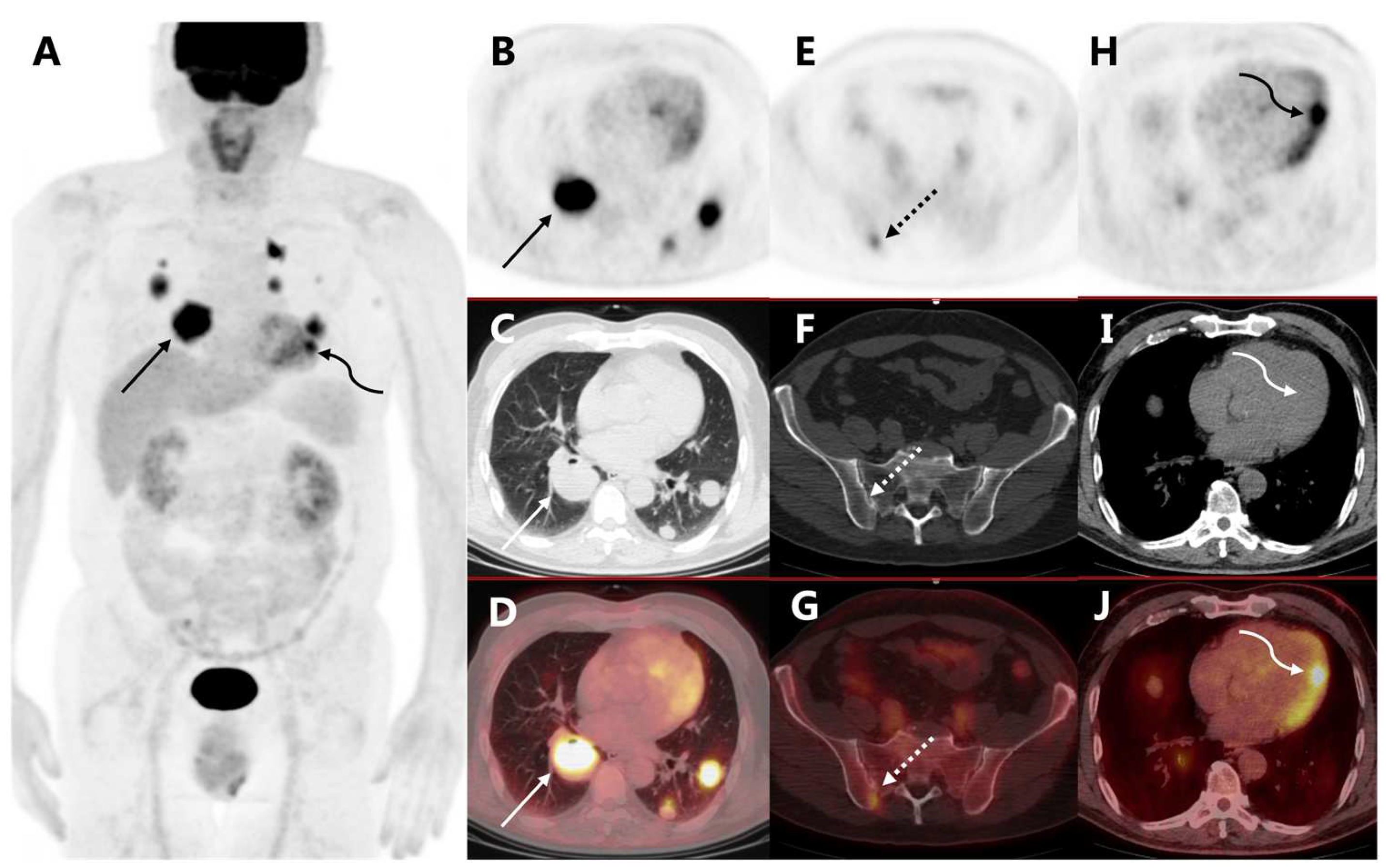 Diagnostics | Free Full-Text | Cardiac Metastasis of Malignant Melanoma ...