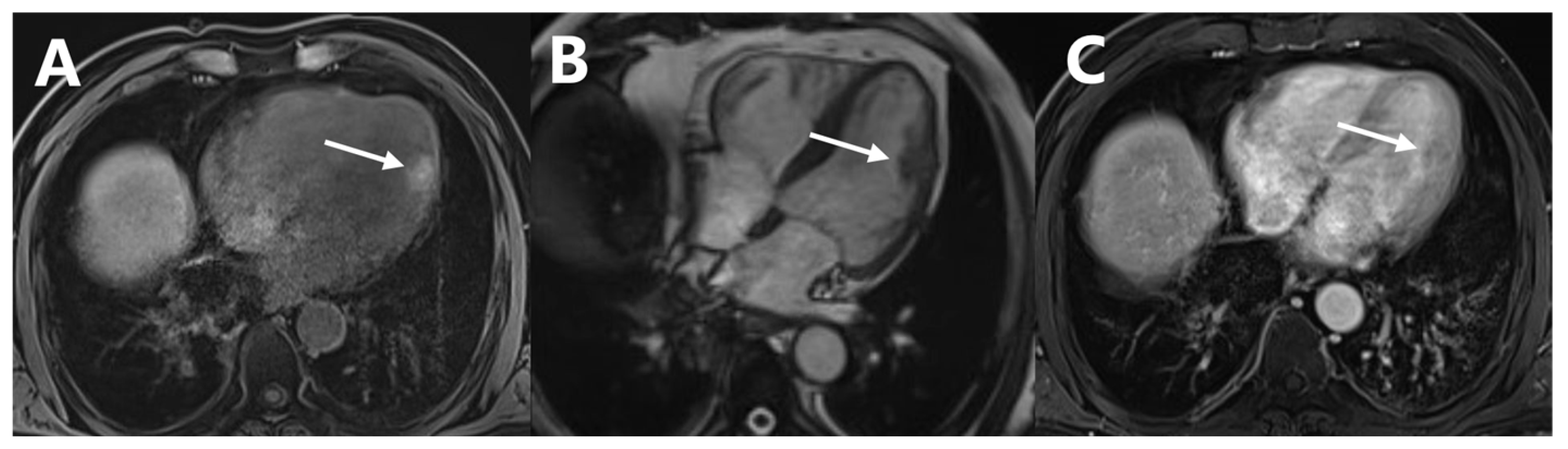 Cardiac Metastasis of Malignant Melanoma Detected by 18F-FDG PET/CT