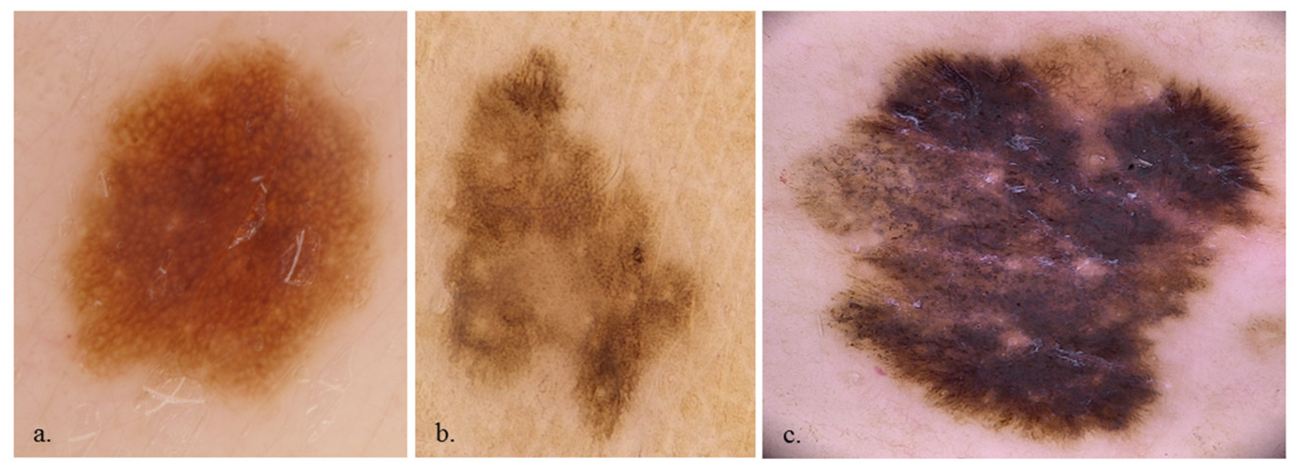 Super-High Magnification Dermoscopy in 190 Clinically
