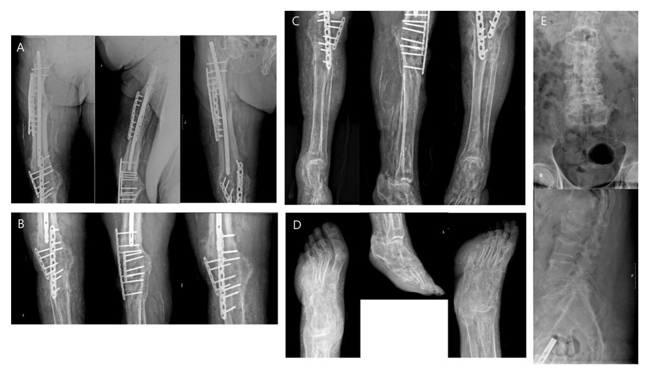 Diagnostics Free FullText 18FFDG PET/CT and WholeBody Bone Scan