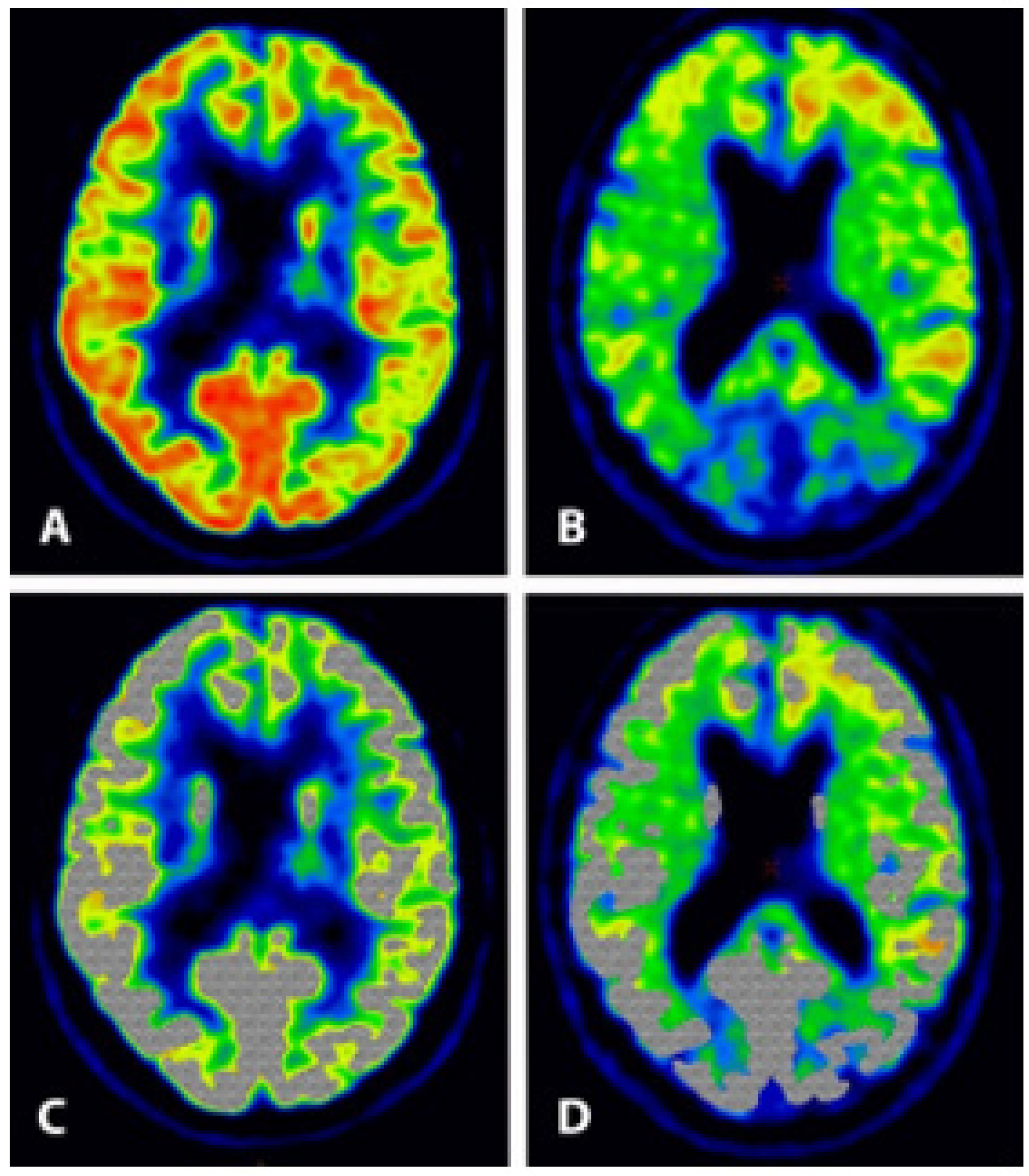 Diagnostics Free Full Text FDG PET Versus Amyloid PET Imaging For diagnostics-free-full-text-fdg-pet-versus-amyloid-pet-imaging-for