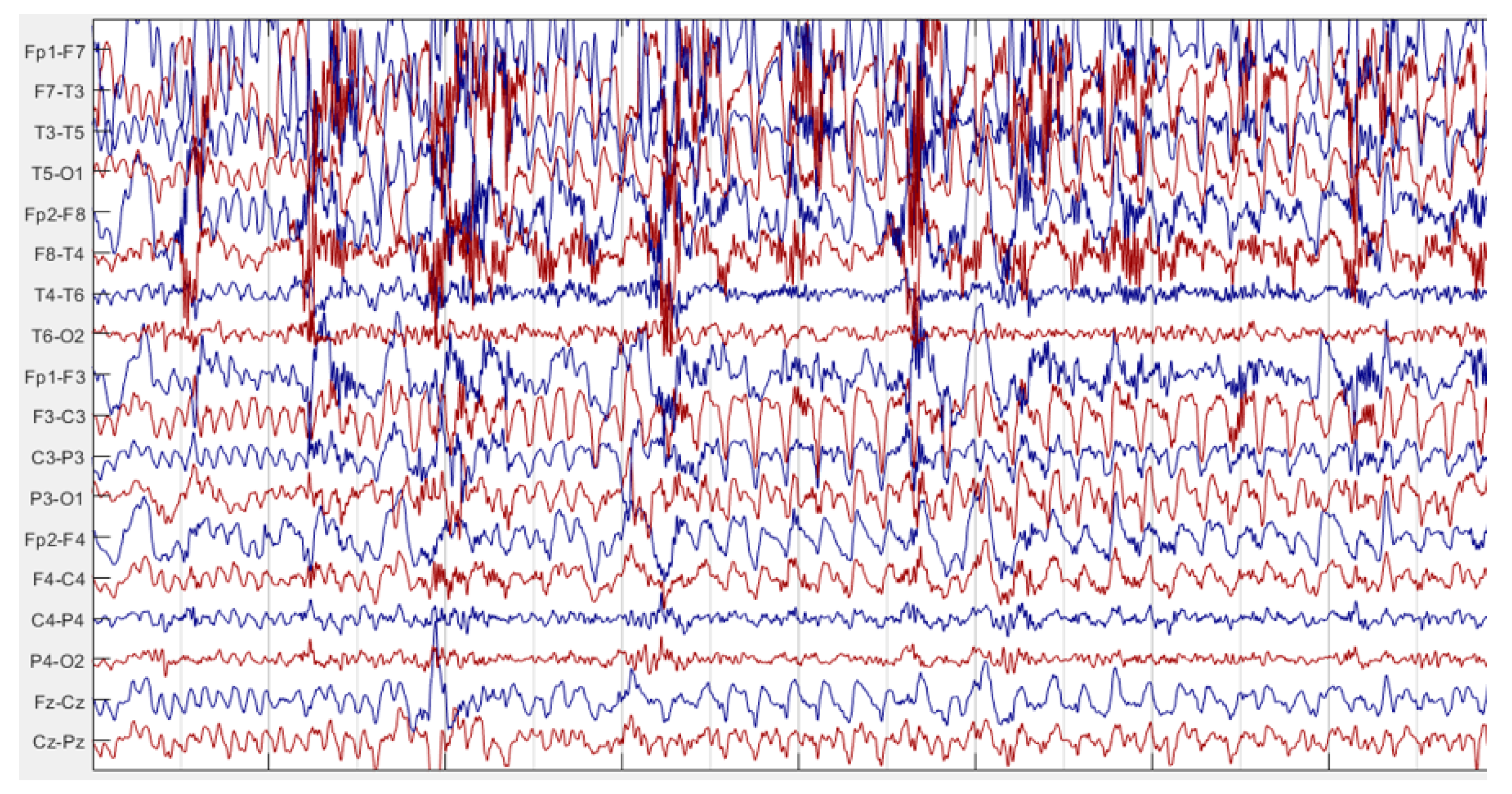Diagnostics Free FullText Identification of TLE Focus from EEG