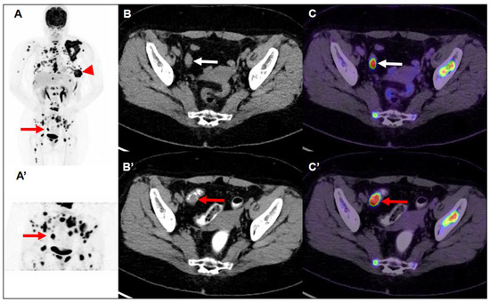 Utility of FDG PET/CT in Patient with Synchronous Breast and Colon Cancer
