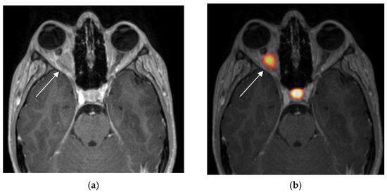 Optic Nerve Sheath Meningiomas: Solving Diagnostic Challenges with 68Ga ...