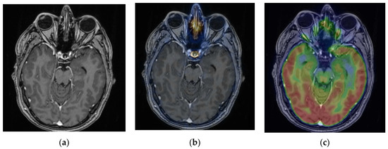 Optic Nerve Sheath Meningiomas: Solving Diagnostic Challenges with 68Ga ...