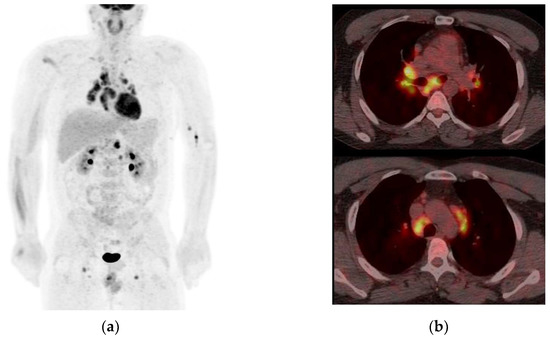 Optic Nerve Sheath Meningiomas: Solving Diagnostic Challenges with 68Ga ...