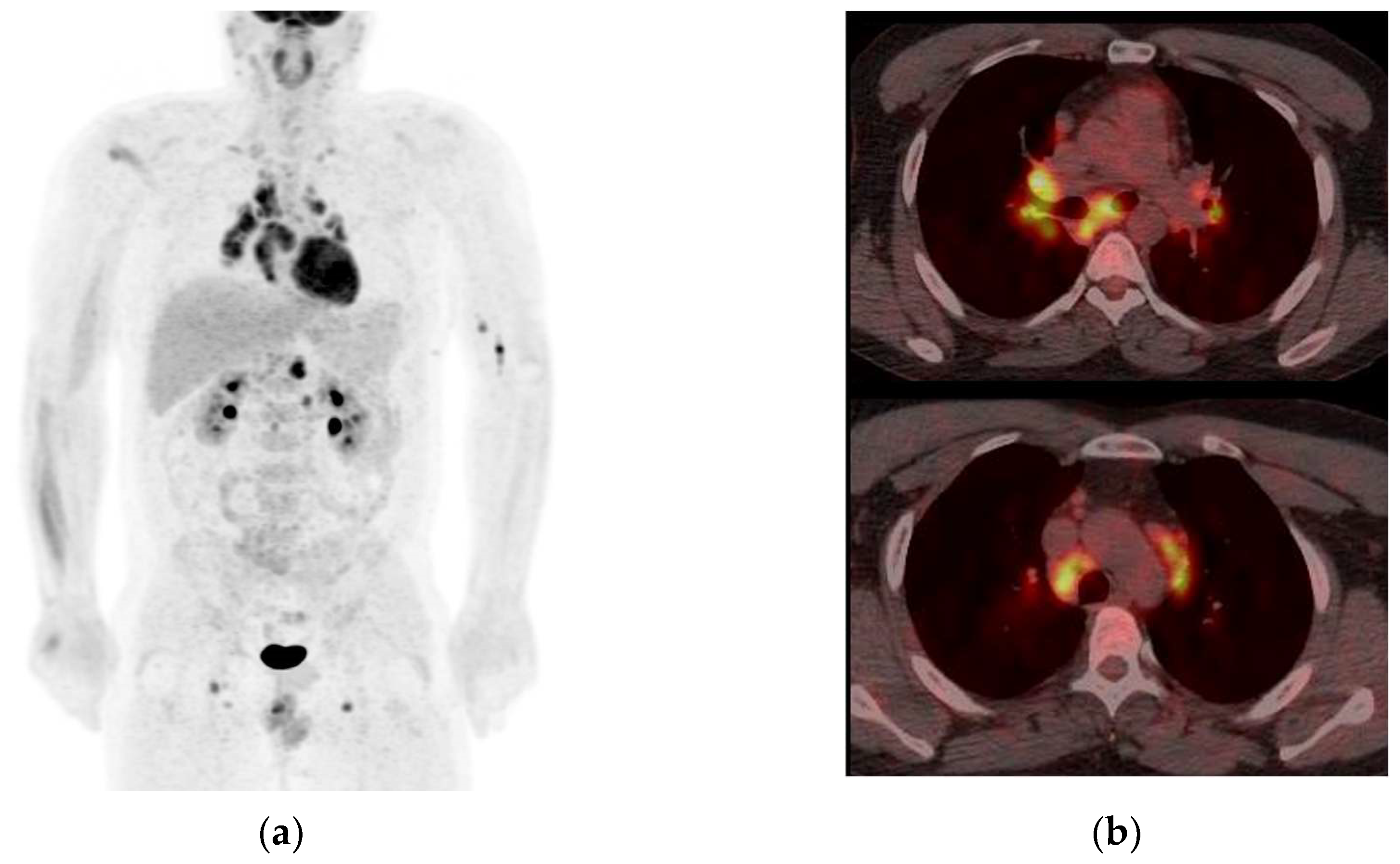 Optic Nerve Sheath Meningiomas: Solving Diagnostic Challenges with 68Ga ...