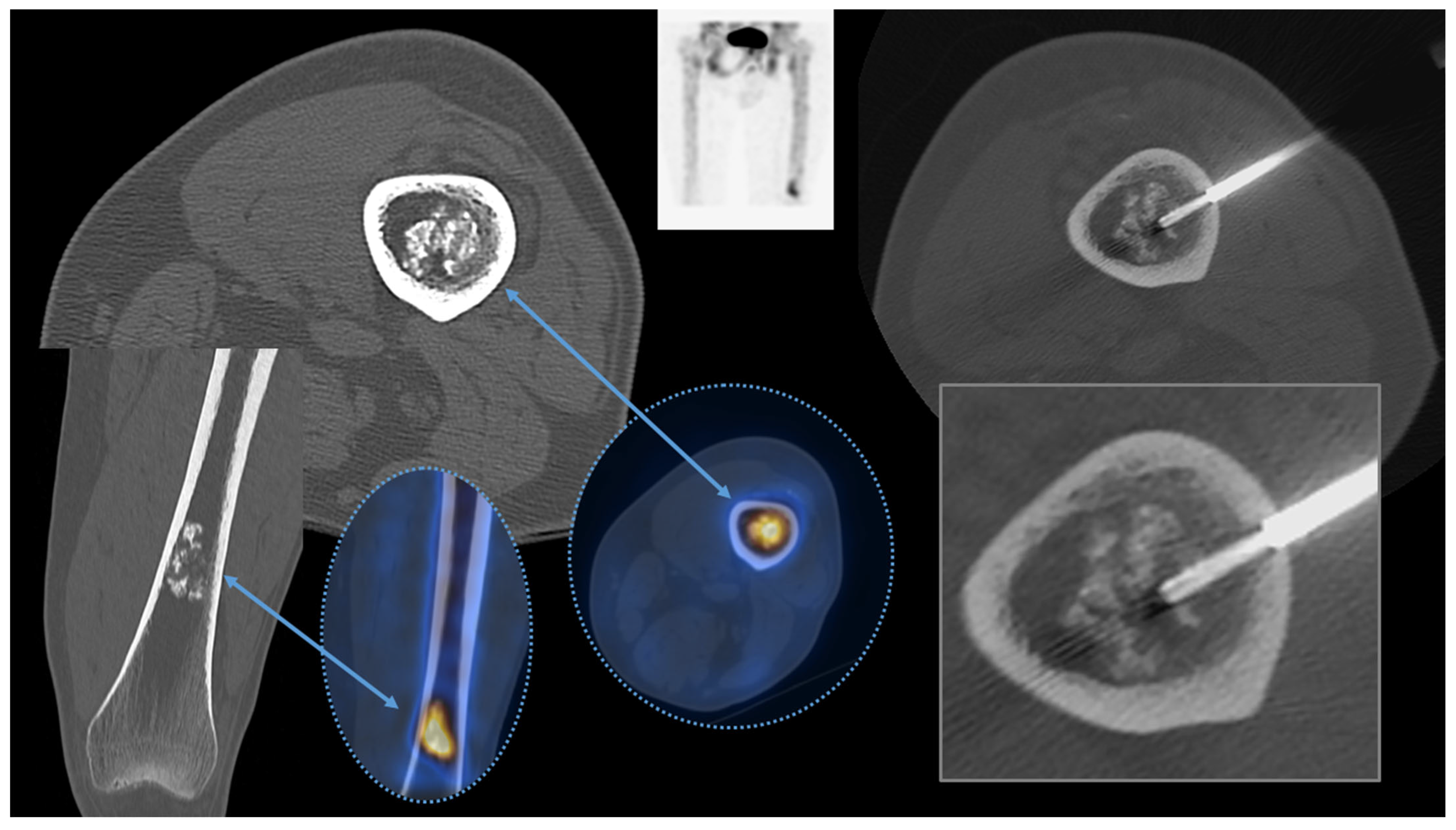 Overcoming CT-to-Body Divergence to Biopsy, Definitively Diagnose and Mark  a Subcentimeter Lesion