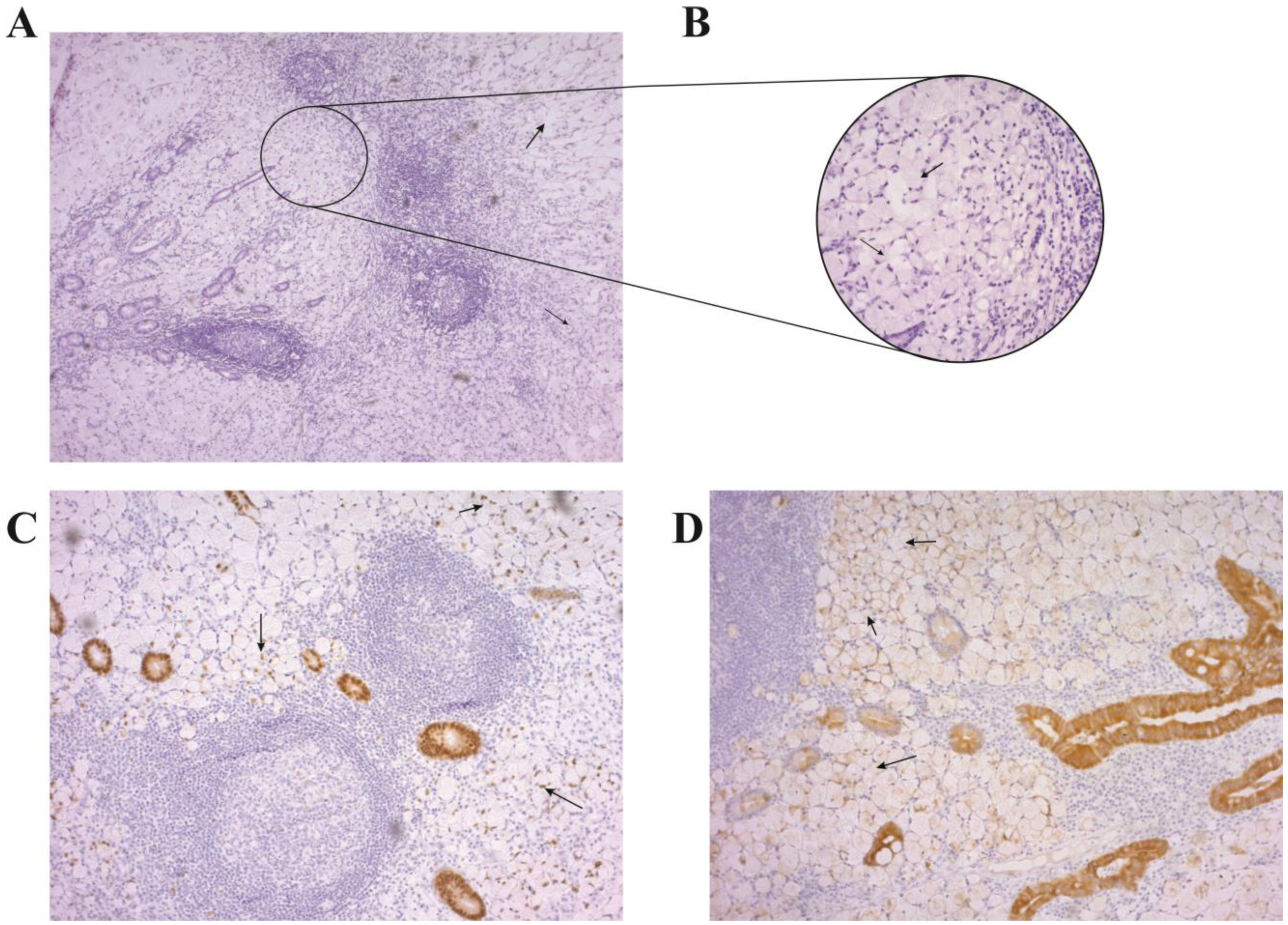 Poorly cohesive gastric carcinoma - Wikipedia